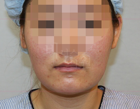 턱지방흡입 수술 후 정면 — 턱선 정리