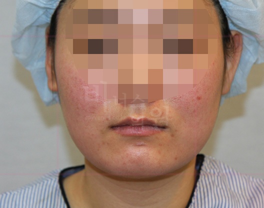 턱지방흡입 수술 전 정면 — 이중턱·볼 지방