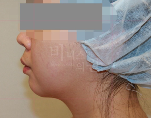 턱지방흡입 수술 후 측면 — 턱목 라인 정리