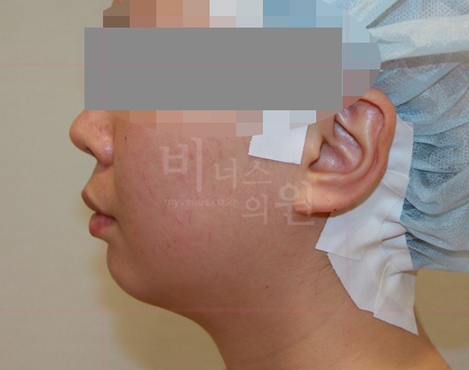 턱지방흡입 수술 전 측면 — 목 라인