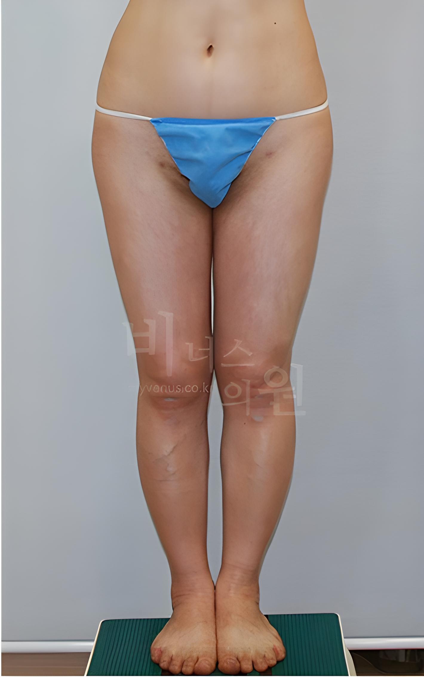 허벅지지방흡입 수술 후 정면 사진