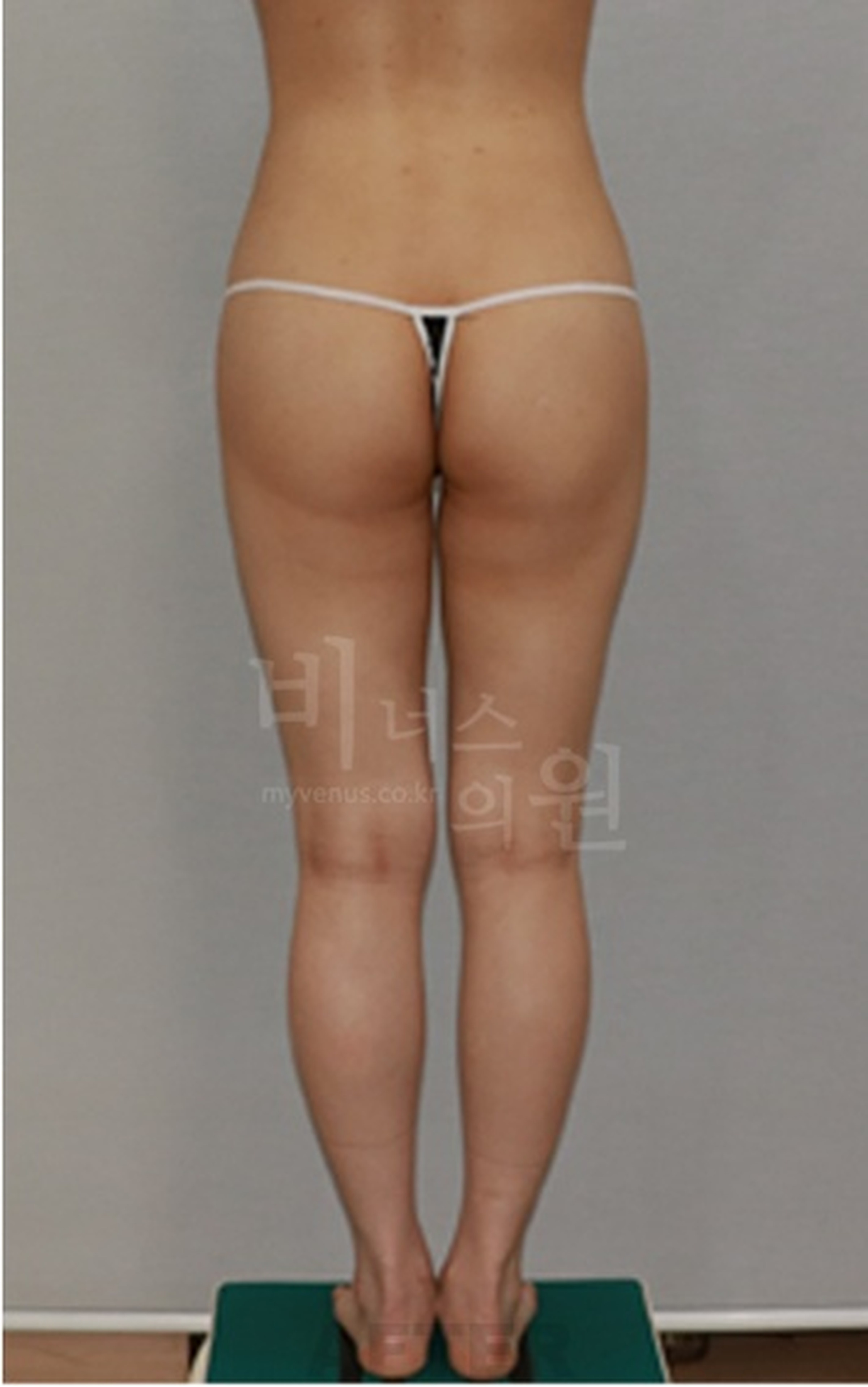 엉덩이축소 지방흡입 수술 후 정면