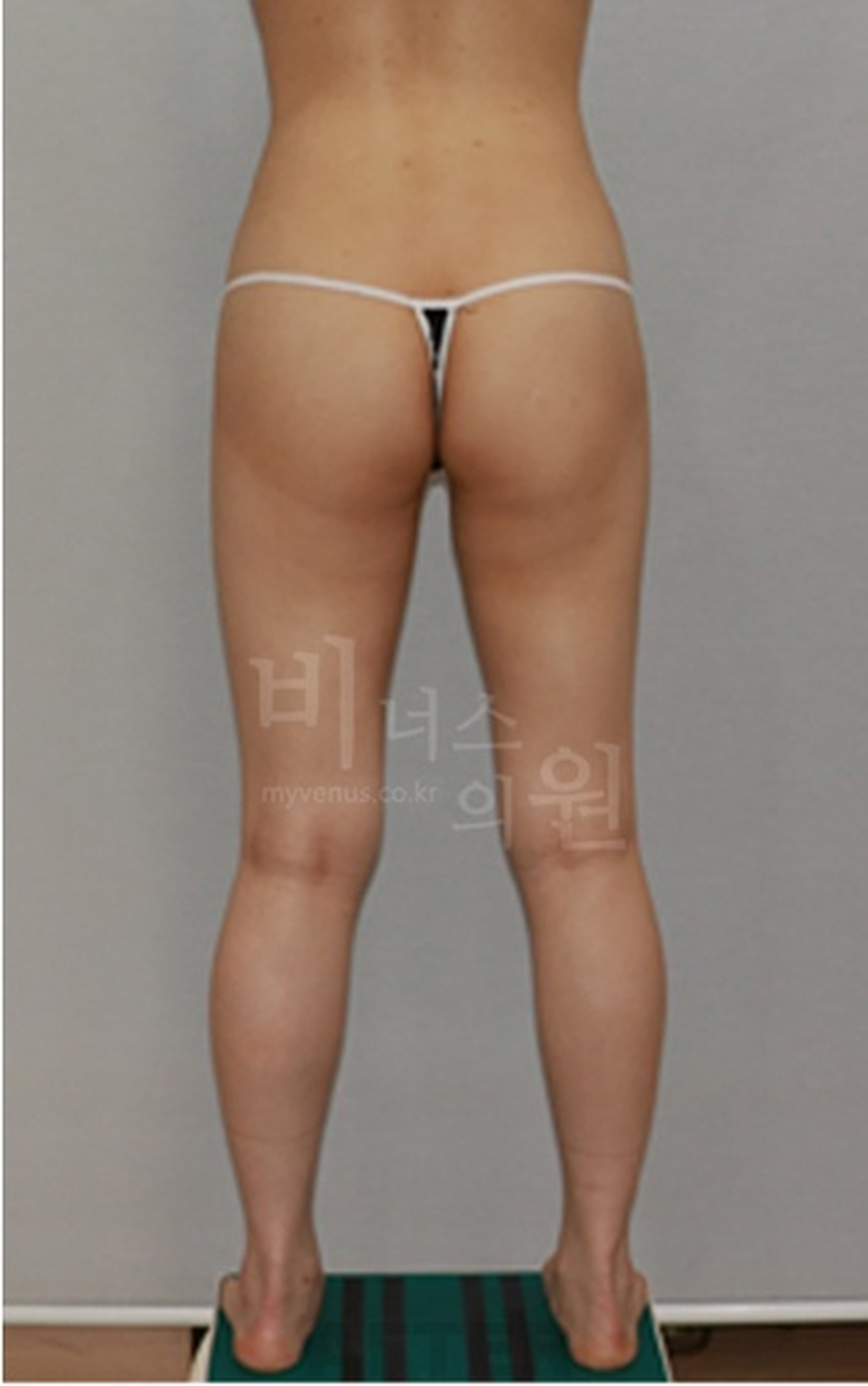 엉덩이축소 지방흡입 수술 후 정면 다른 각도