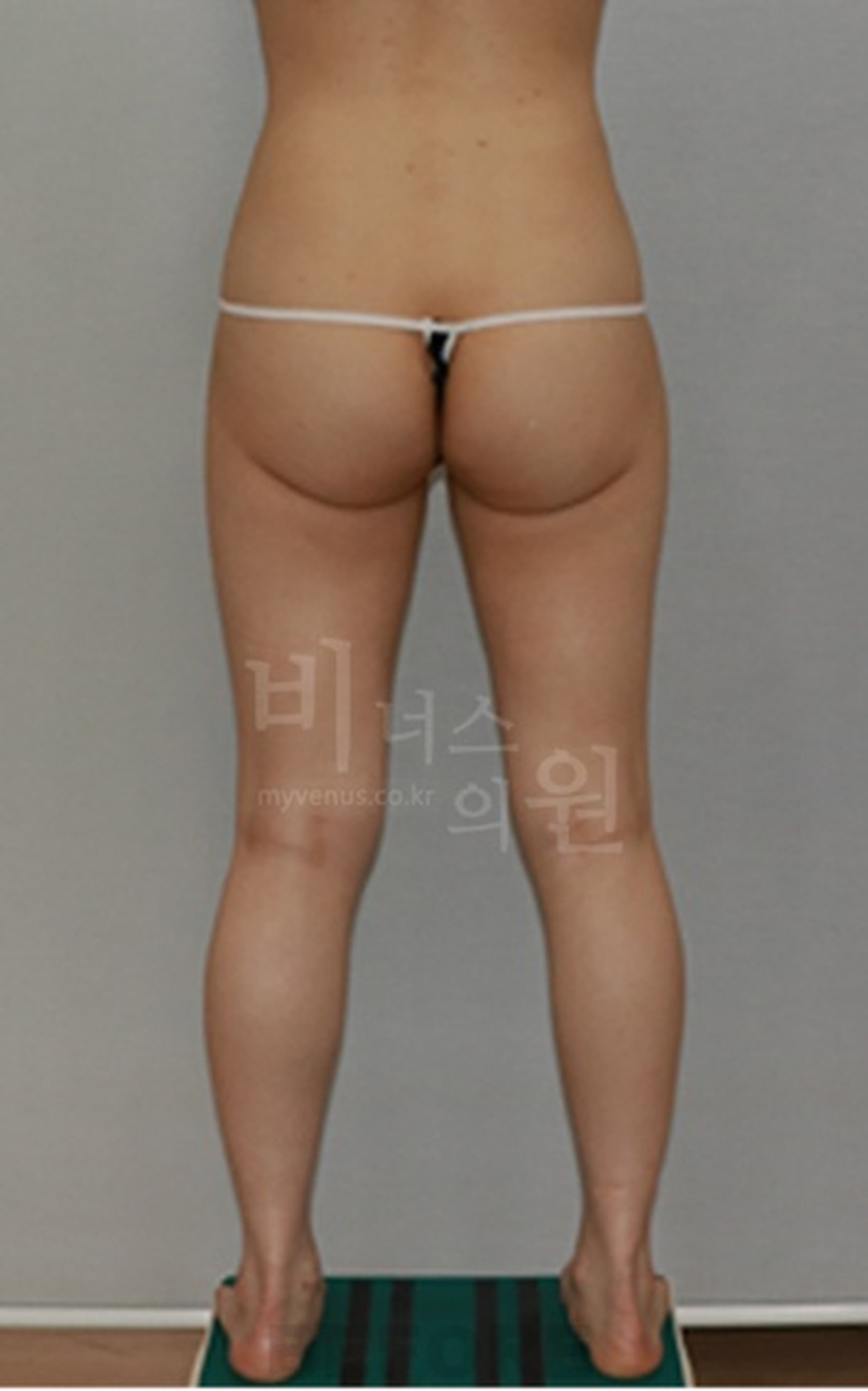 엉덩이축소 지방흡입 수술 전 정면 다른 각도