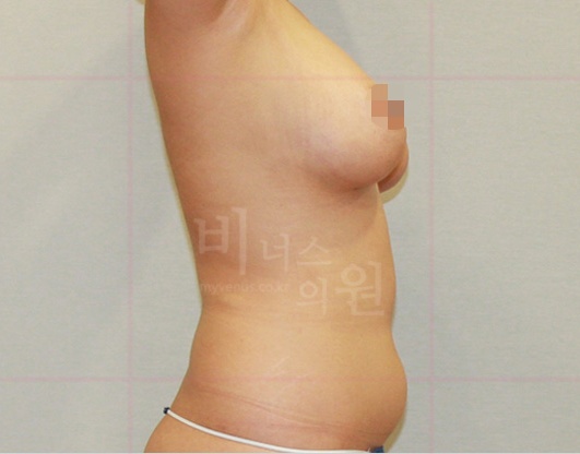 가슴축소 지방흡입 수술 후 정면 사례2