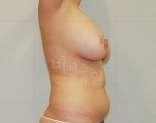 가슴축소 지방흡입 수술 전 정면 사례2