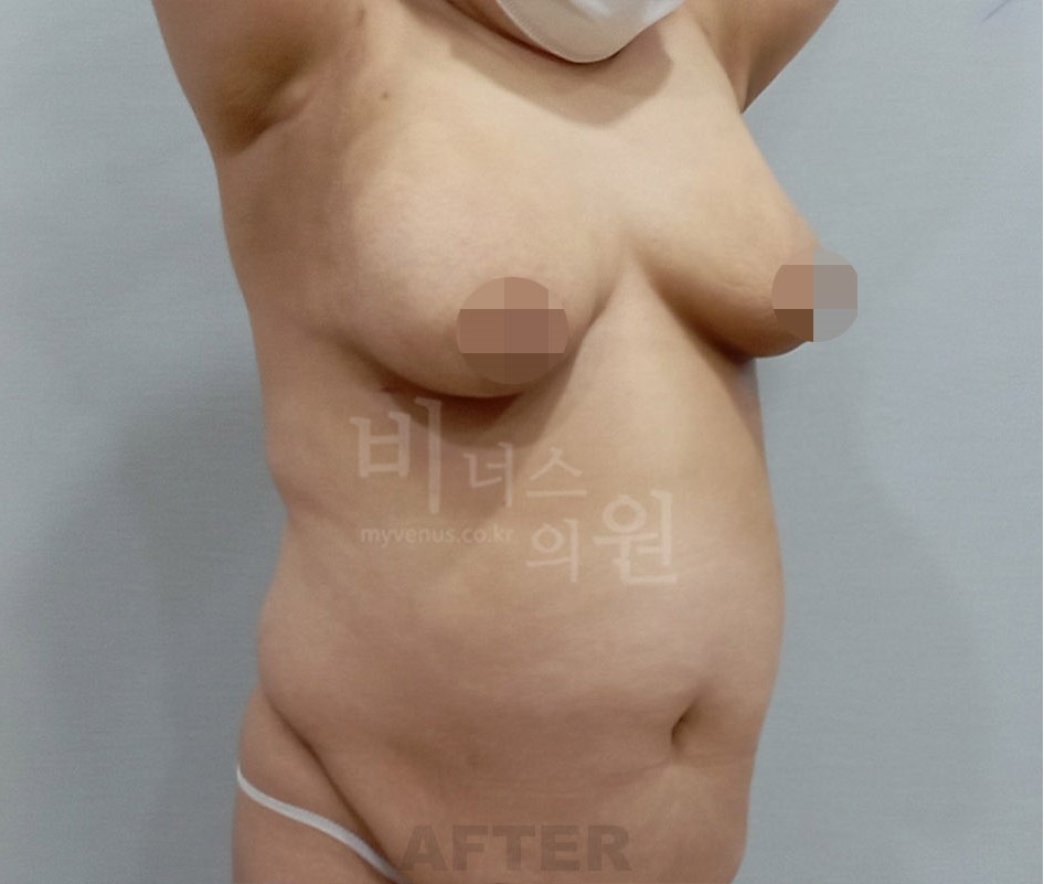 가슴축소 지방흡입 수술 후 45도 측면 (2) 사례4