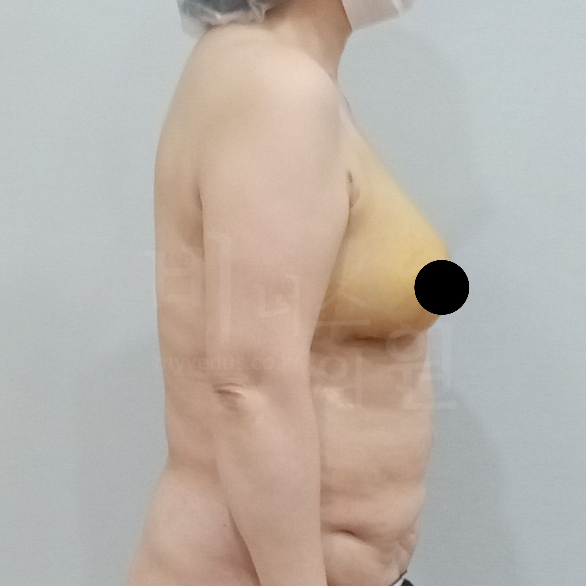 가슴축소 지방흡입 수술 후 측면(90도) 사진