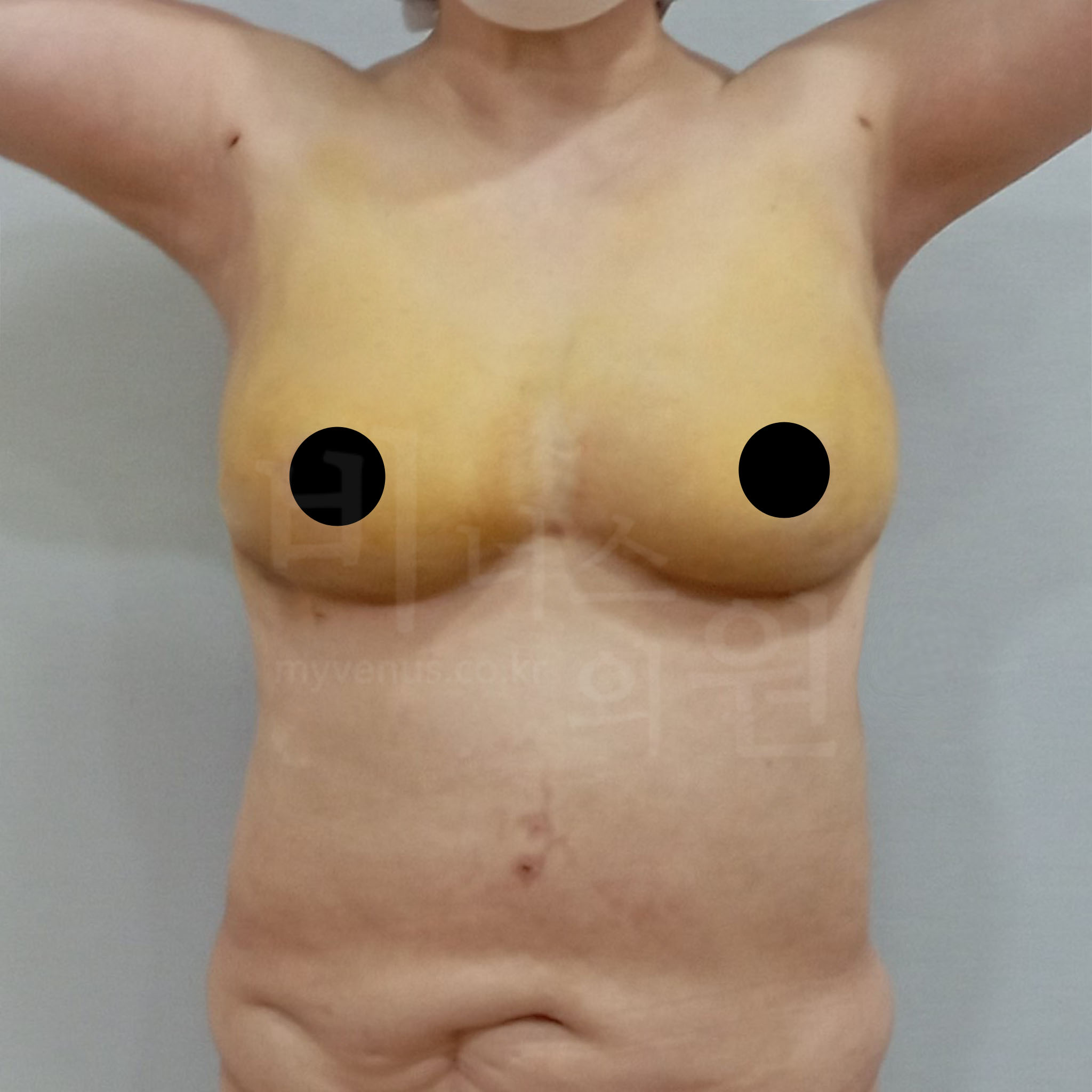 가슴축소 지방흡입 수술 후 정면 사진