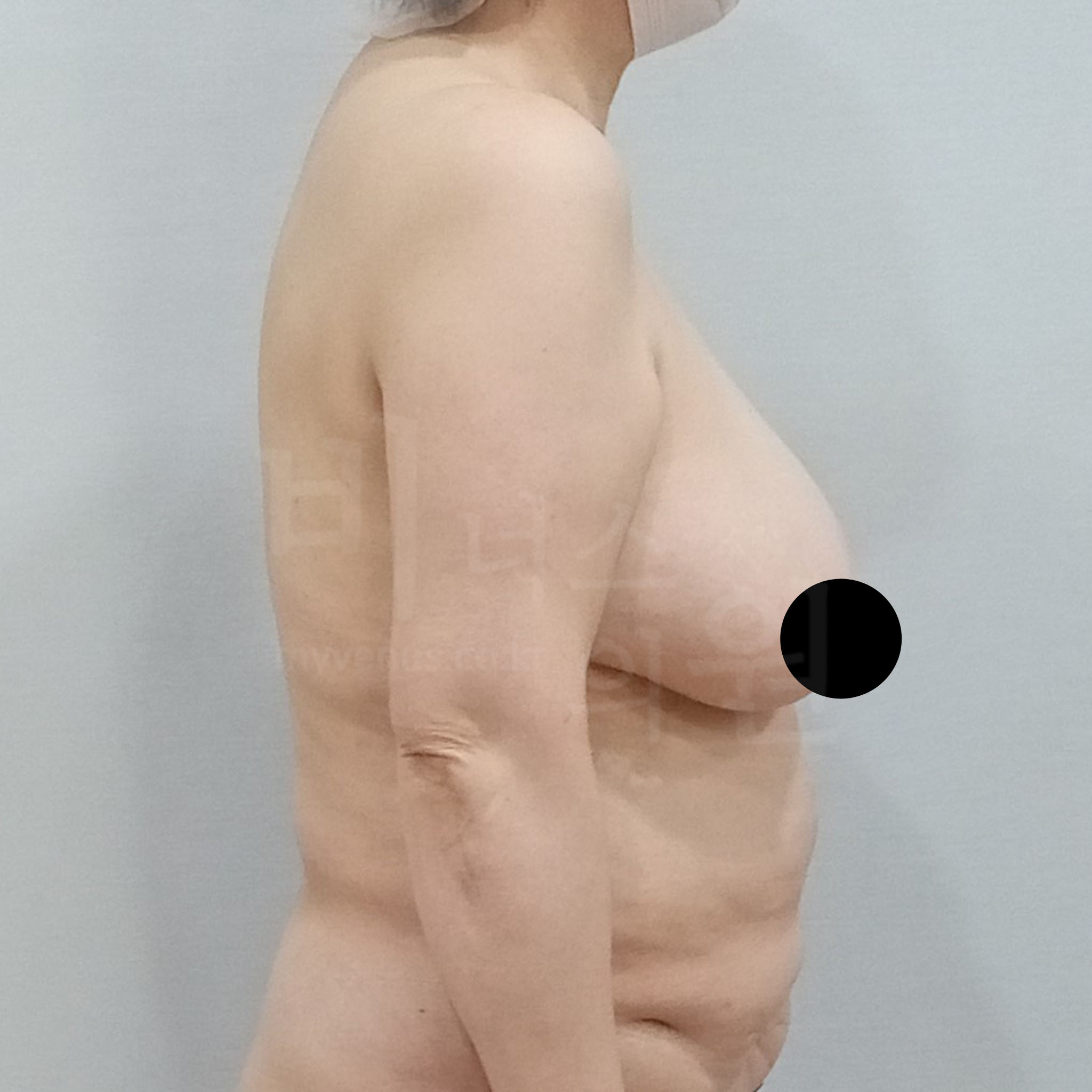 가슴축소 지방흡입 수술 전 측면(90도) 사진