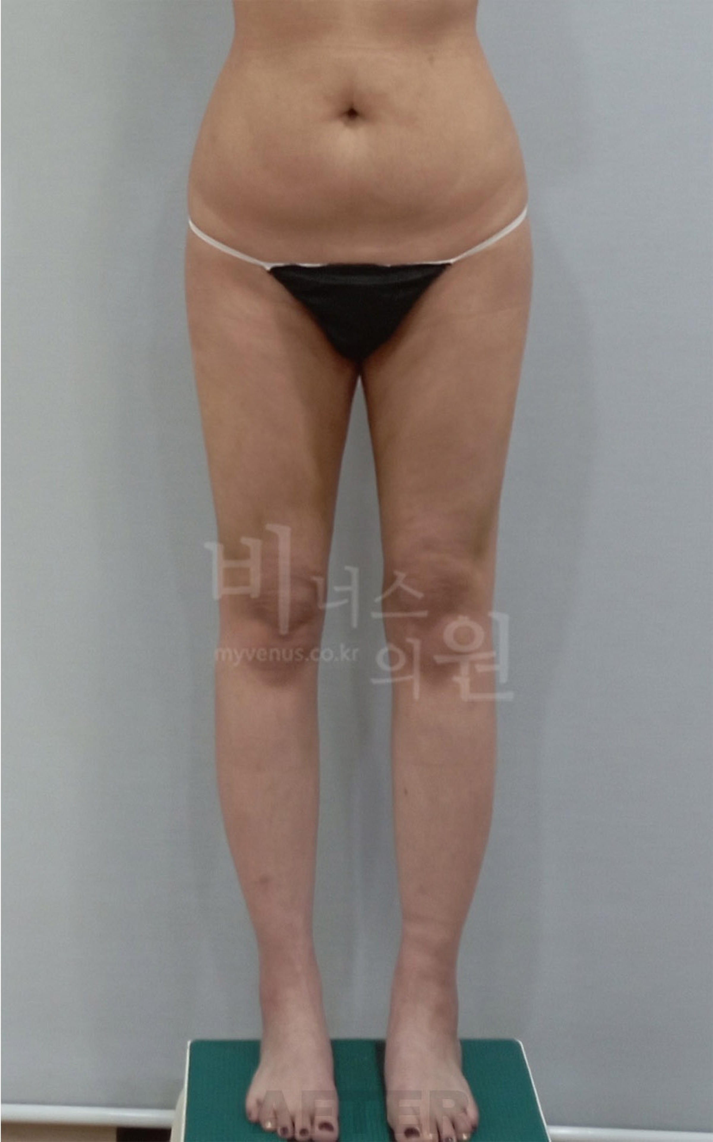엉덩이축소 지방흡입 재수술 후 정면