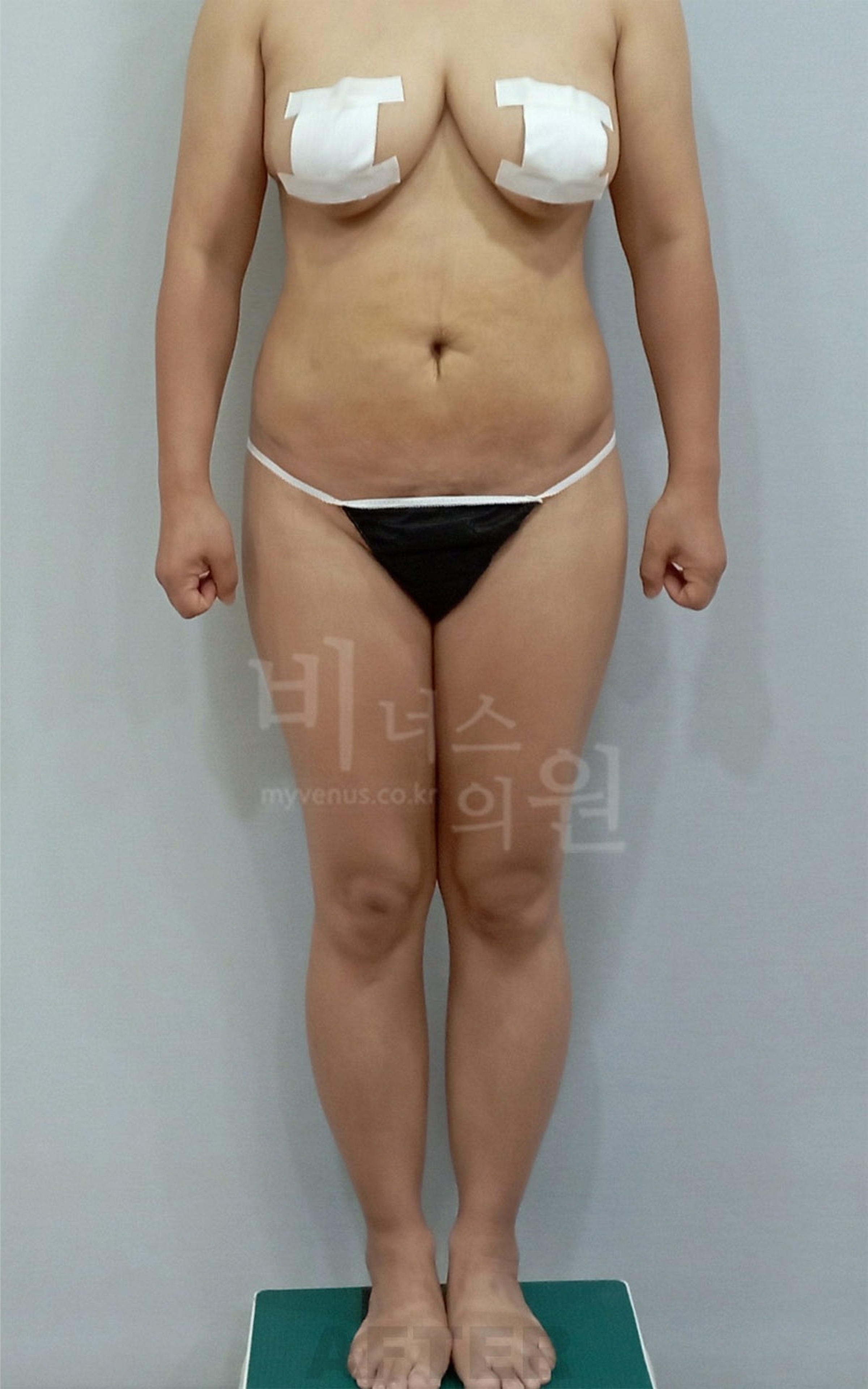 엉덩이축소 수술 후 정면, 골반라인 정돈