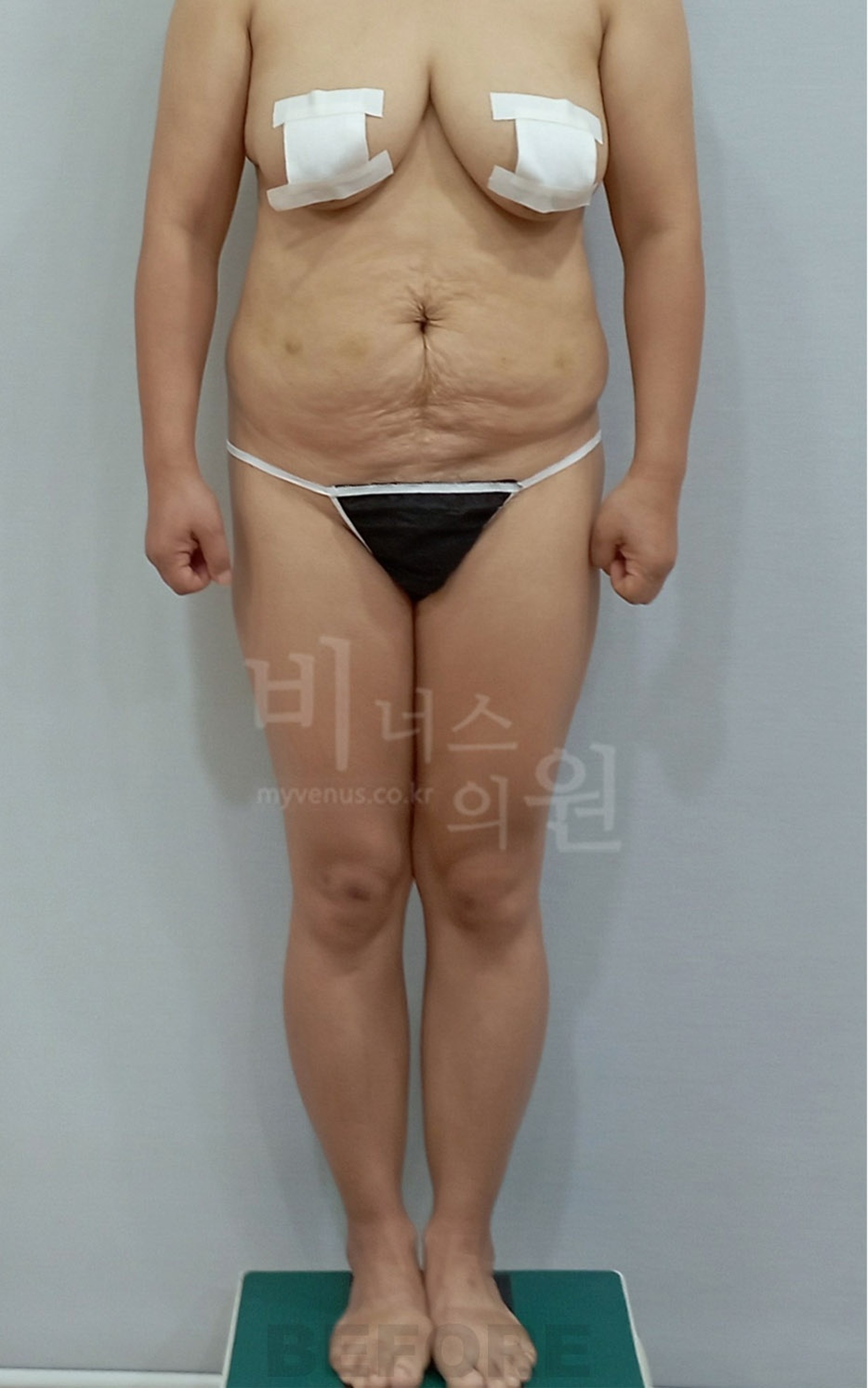 엉덩이축소 수술 전 정면, 골반과 복부 라인