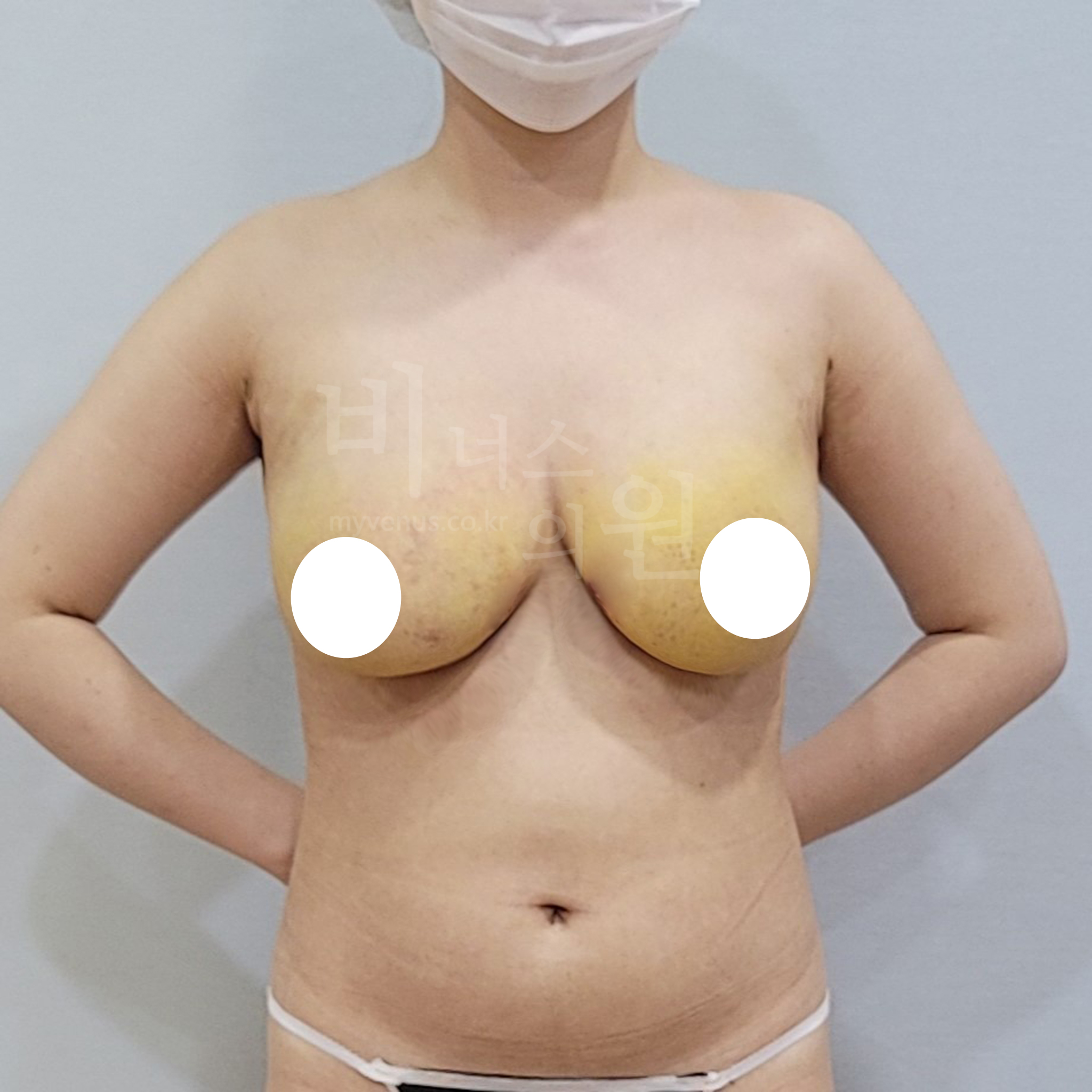 가슴축소 지방흡입 수술 후 정면