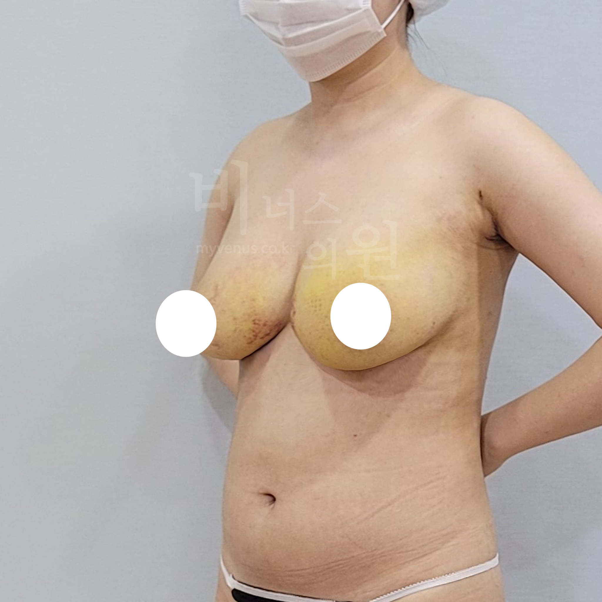 가슴축소 지방흡입 수술 후 45도 측면