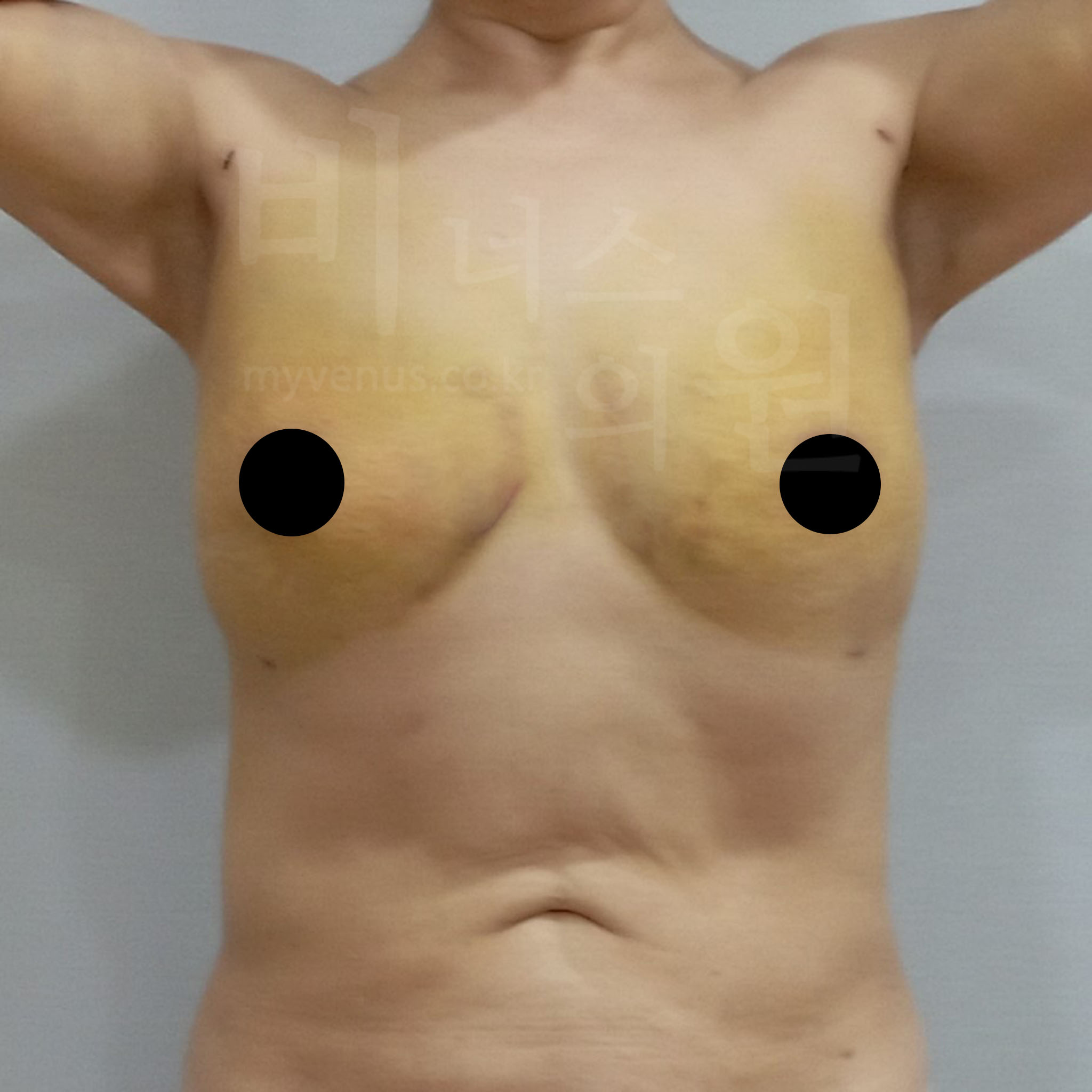 가슴축소 지방흡입 수술 후 정면 사진