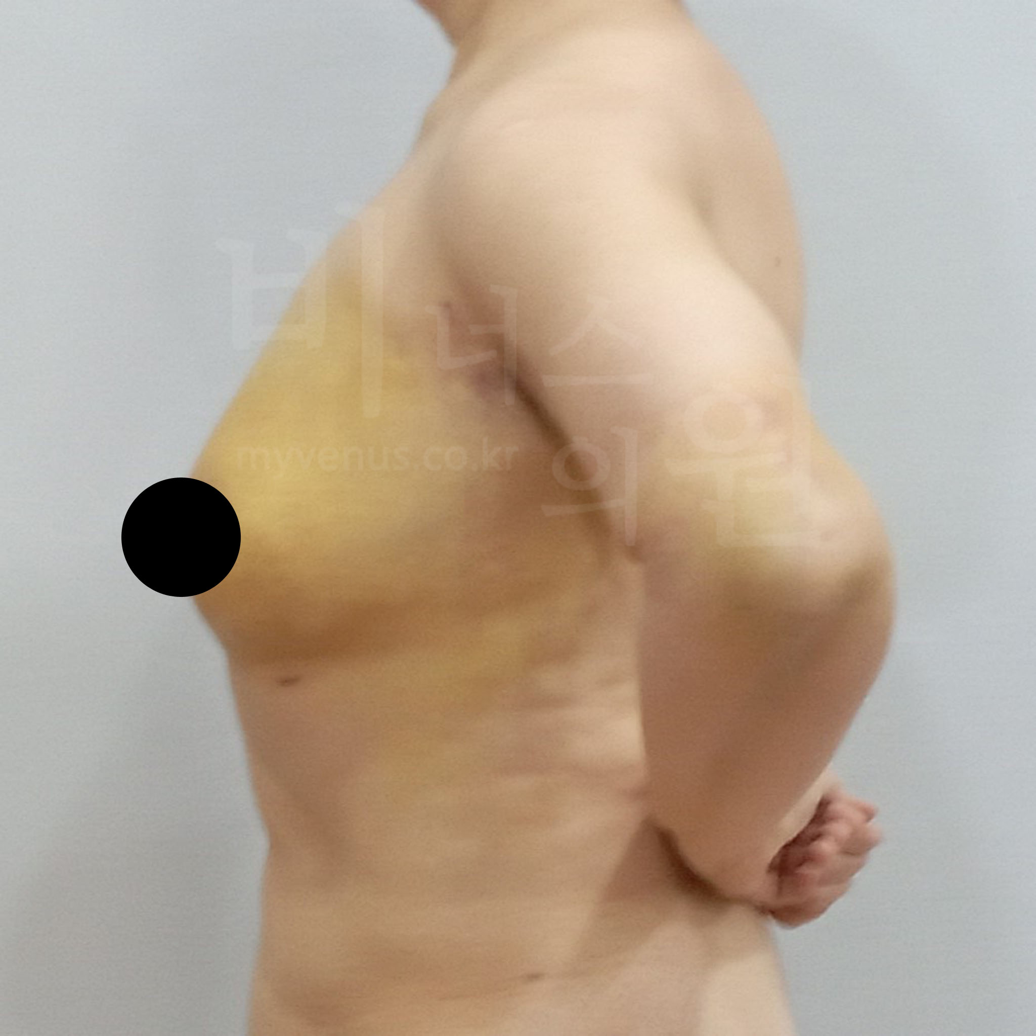 가슴축소 지방흡입 수술 후 측면 사진