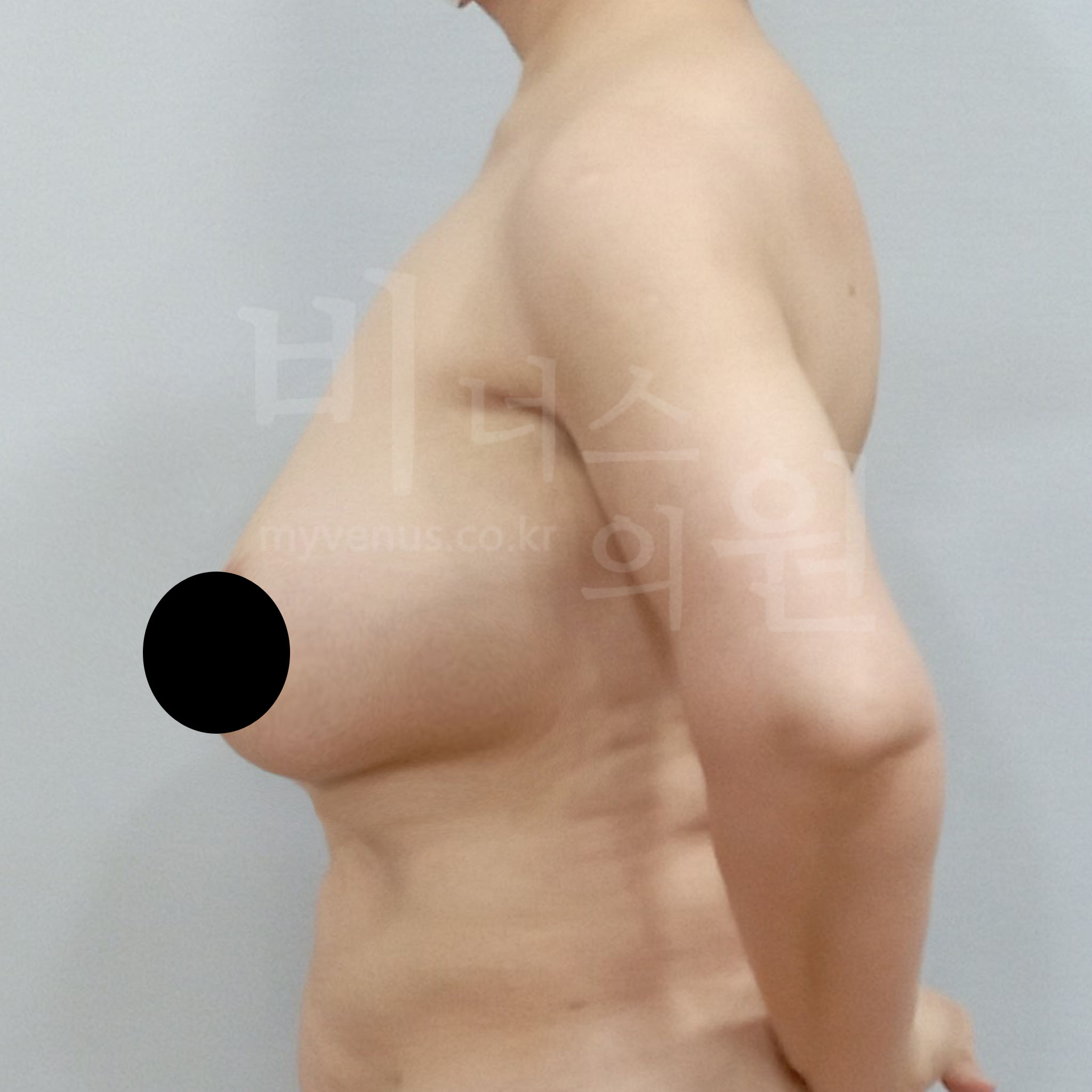 가슴축소 지방흡입 수술 전 측면 사진