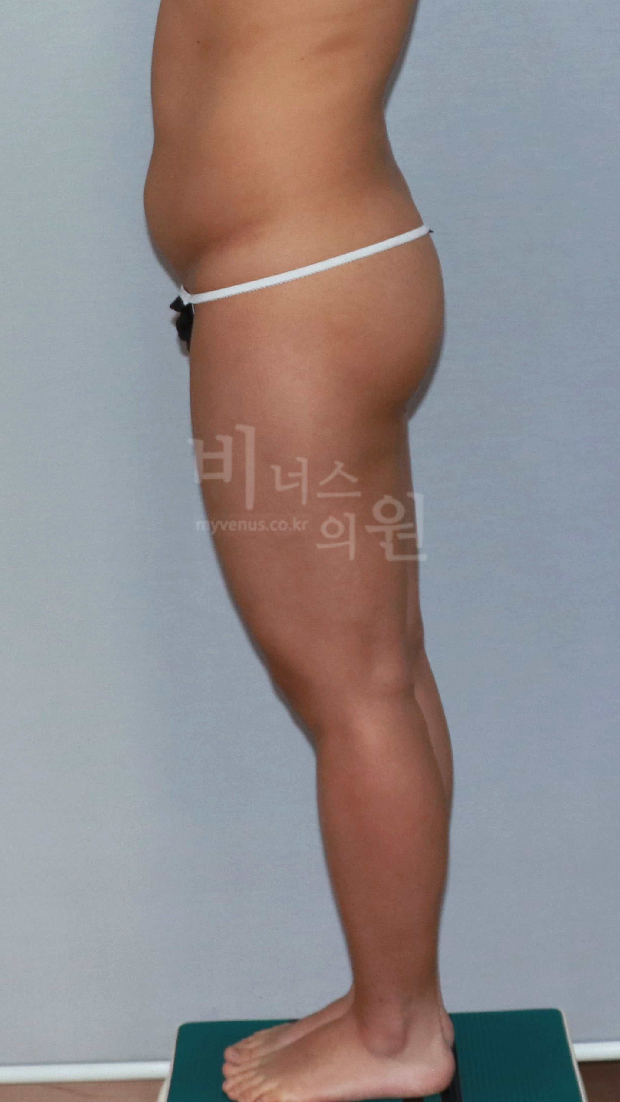 엉덩이축소 지방흡입 수술 전 우측면