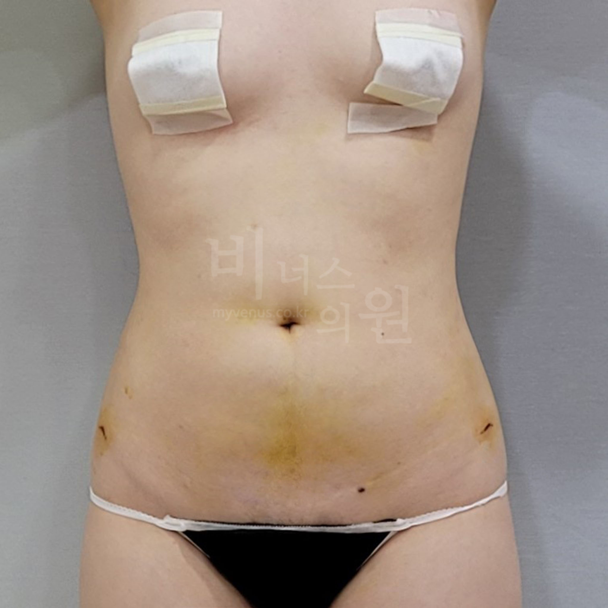 복부지방흡입 수술 후 정면 사진 - 상하복부 옆구리