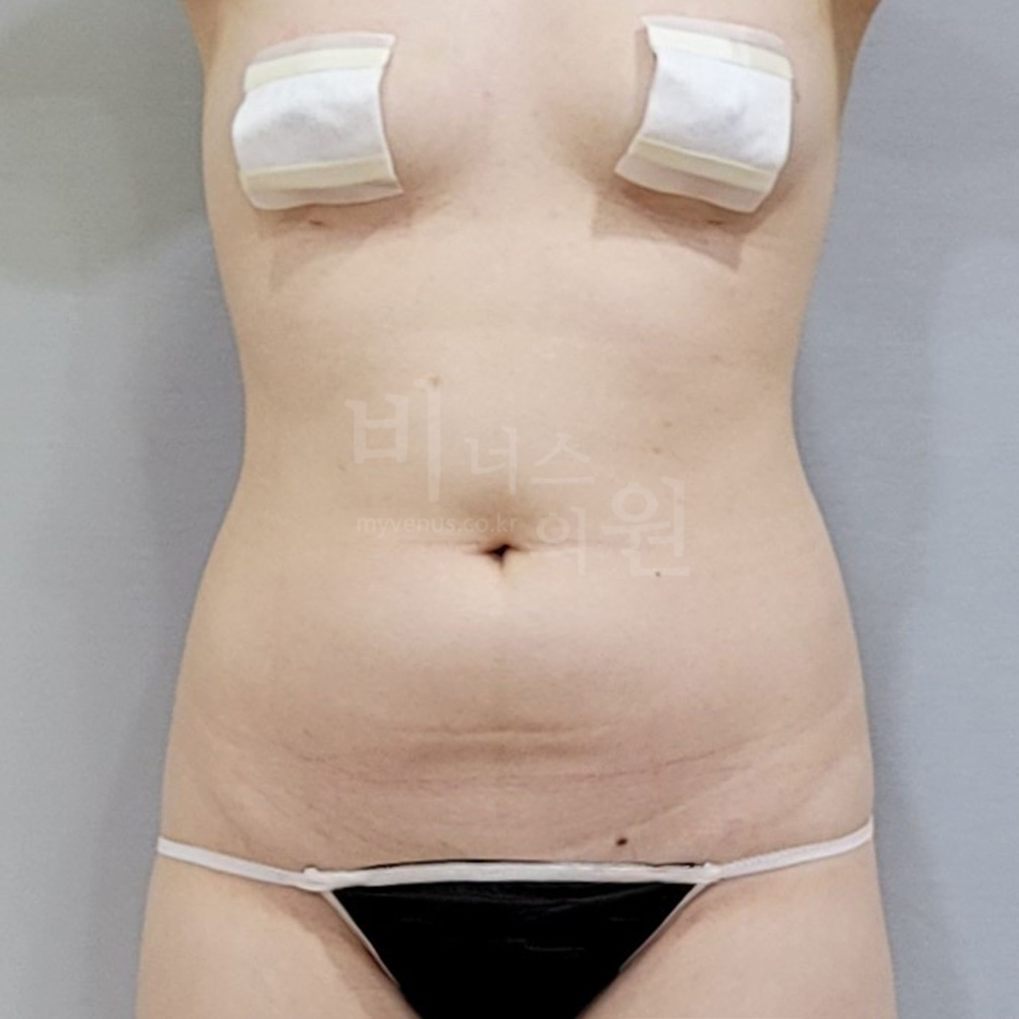 복부지방흡입 수술 전 정면 사진 - 상하복부 옆구리