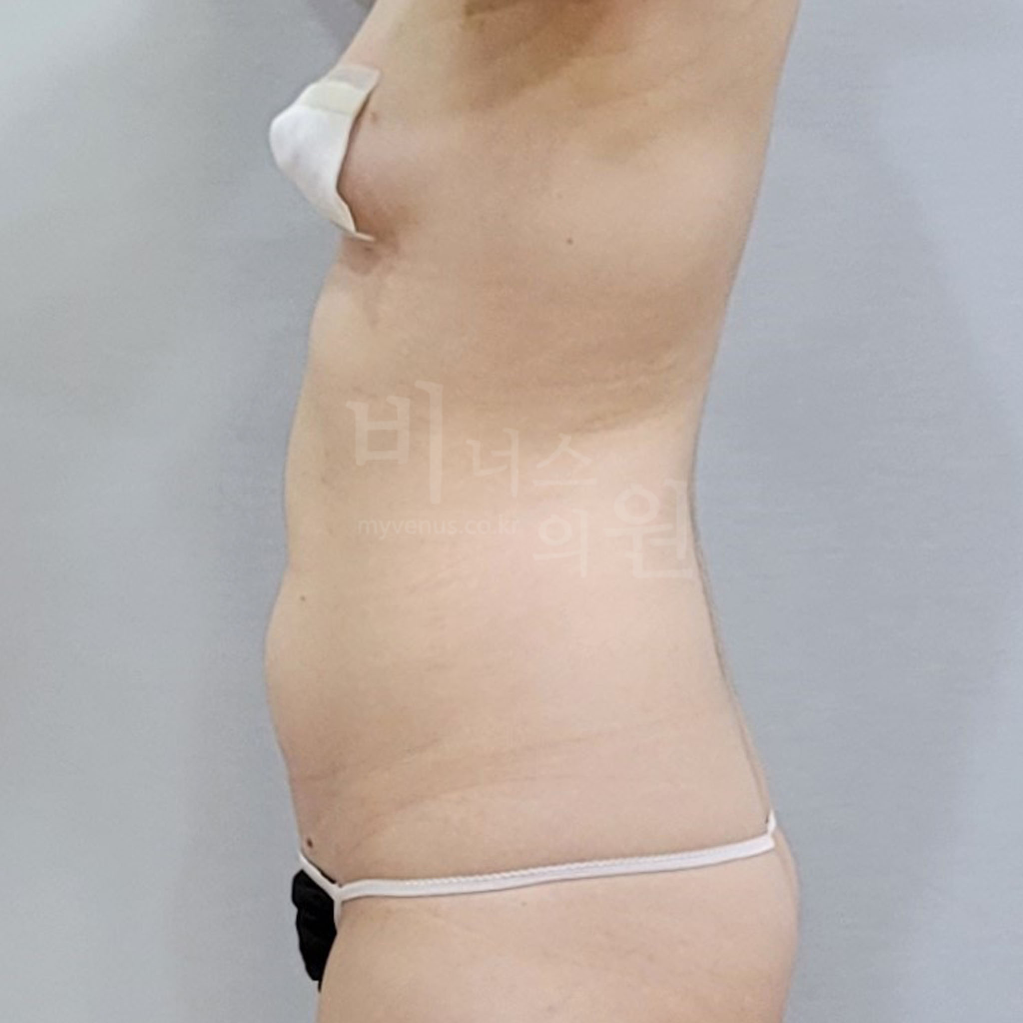 복부지방흡입 수술 전 측면 사진 - 상하복부 옆구리