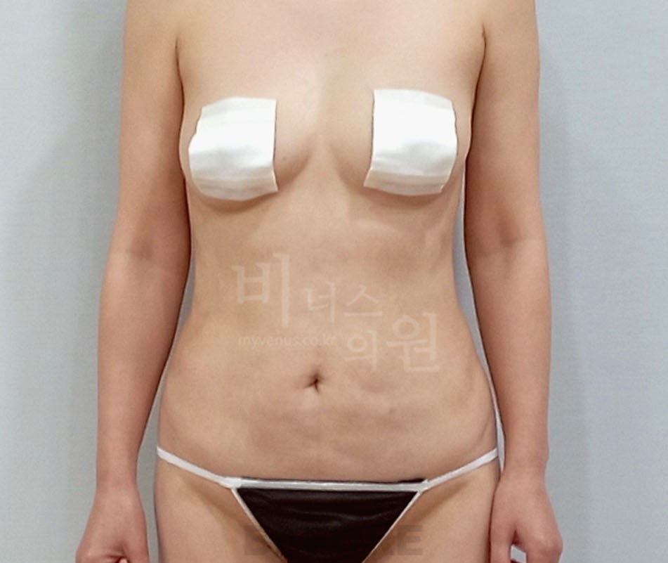 복부지방흡입 수술 전 정면 사진 - 복부 맥시머