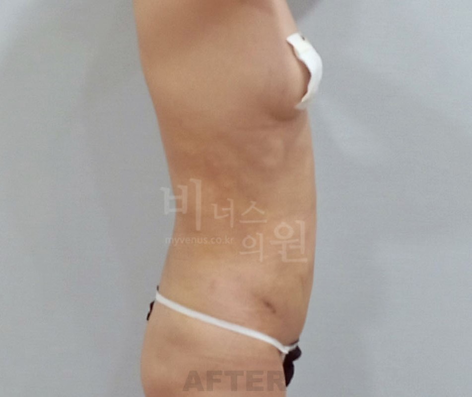 복부지방흡입 수술 후 좌측면 사진 - 복부 맥시머