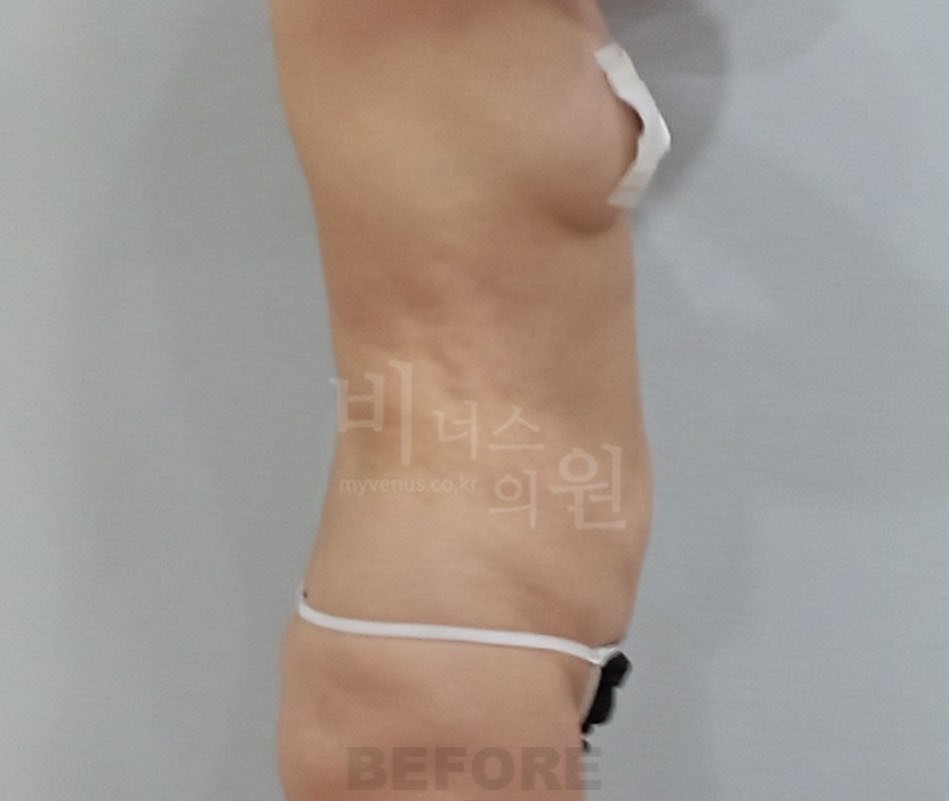 복부지방흡입 수술 전 좌측면 사진 - 복부 맥시머