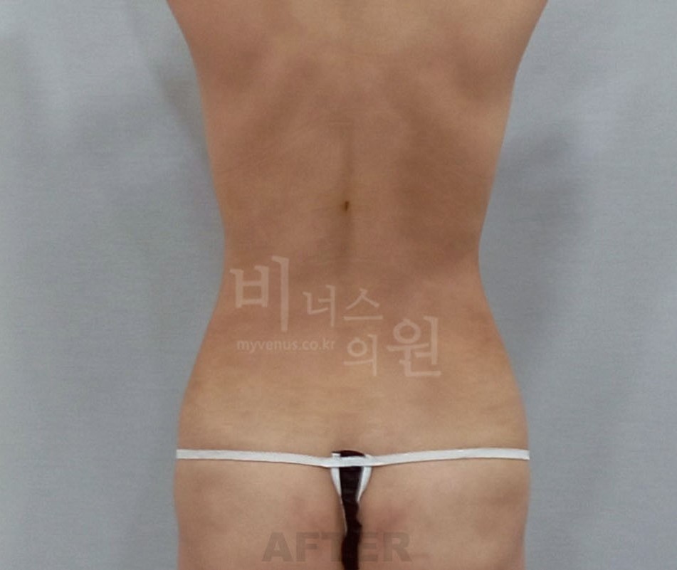 복부지방흡입 수술 후 후면 사진 - 복부 맥시머