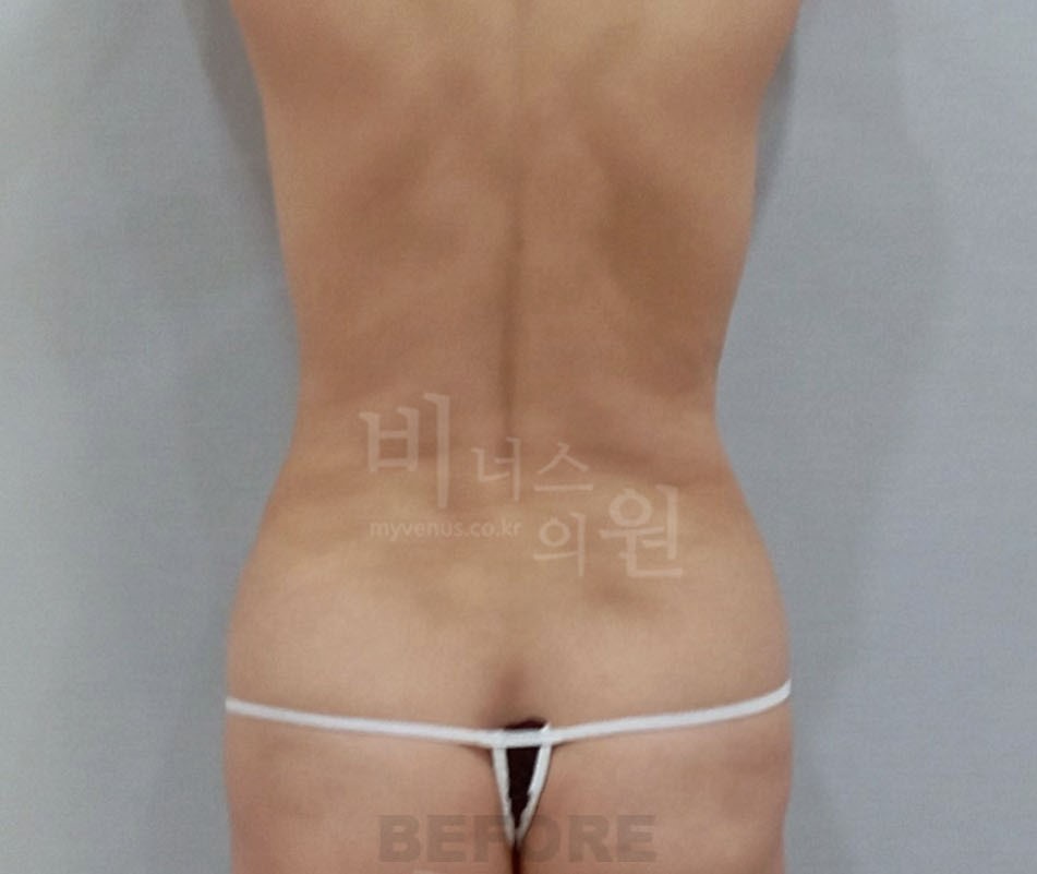 복부지방흡입 수술 전 후면 사진 - 복부 맥시머