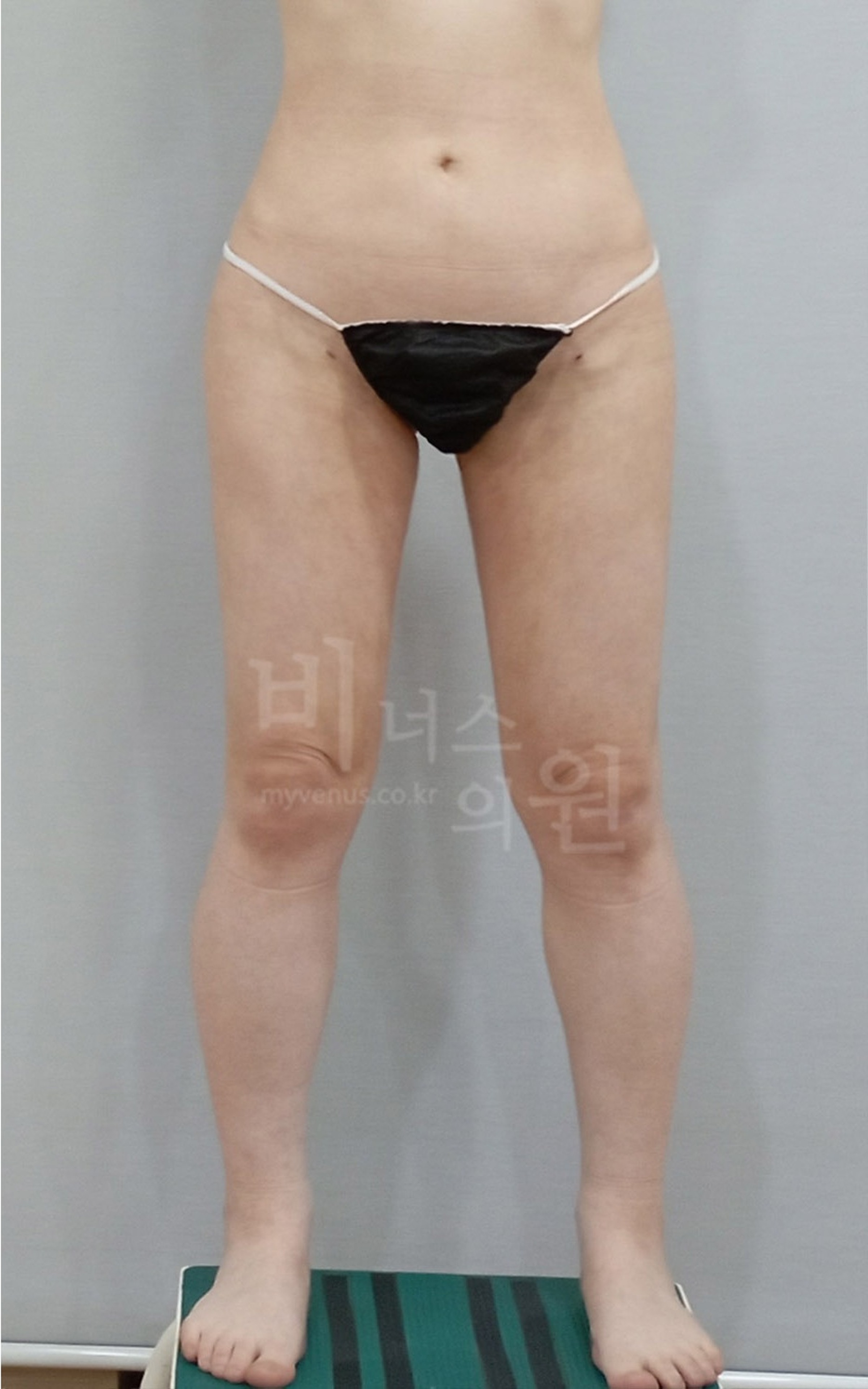 허벅지 지방흡입 재수술 후 정면 사진