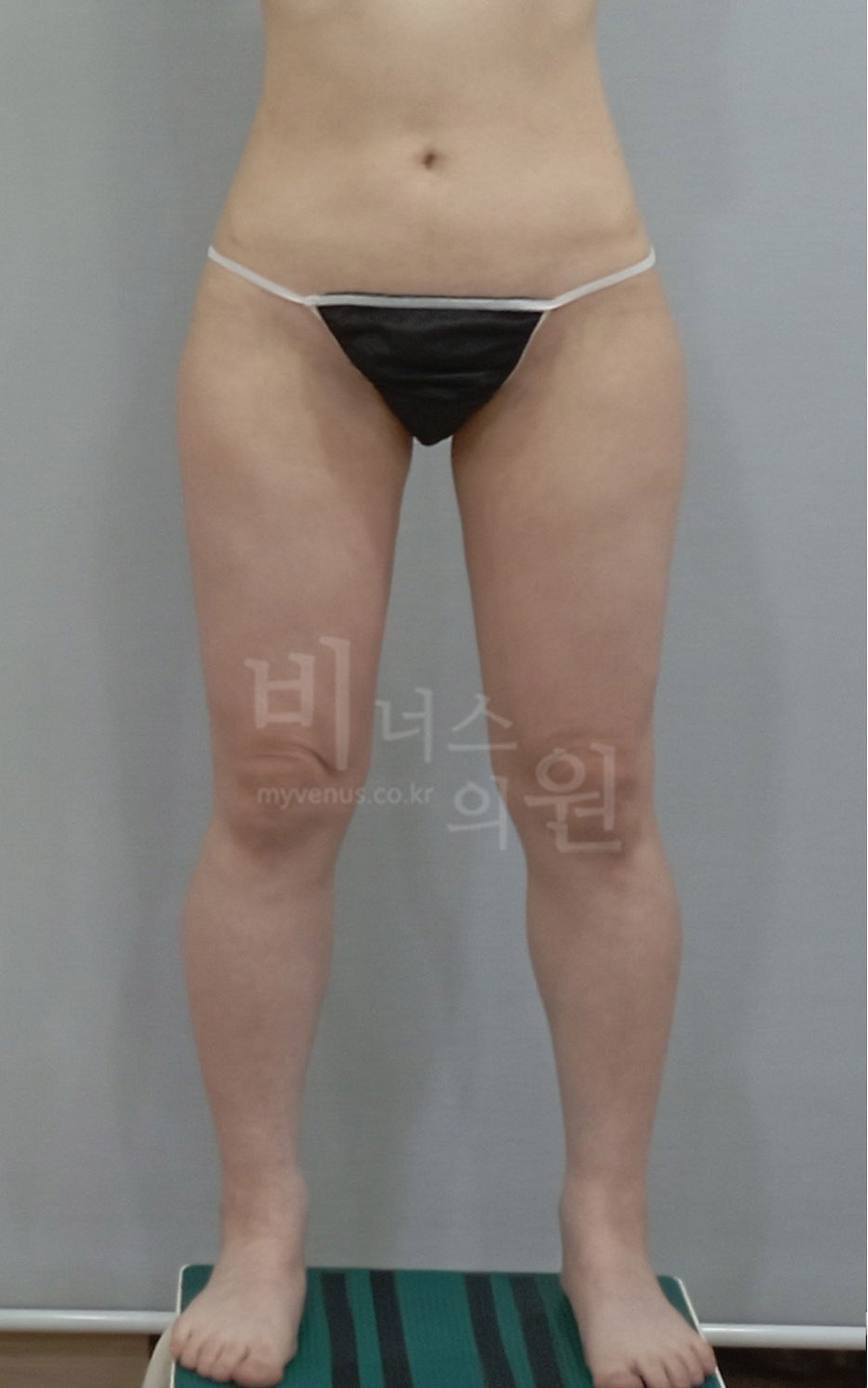 허벅지 지방흡입 재수술 전 정면 사진