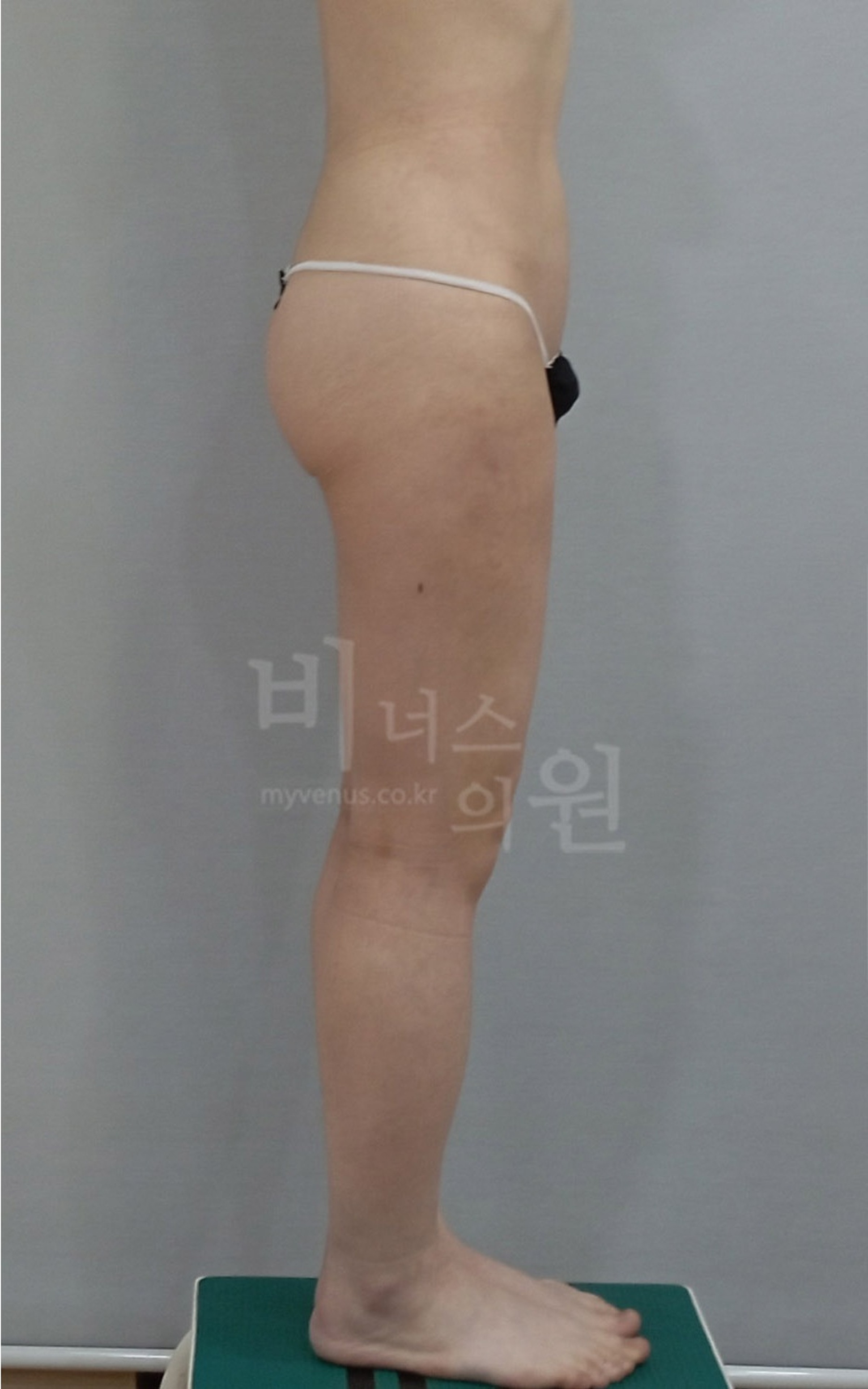 허벅지 지방흡입 재수술 후 측면 사진