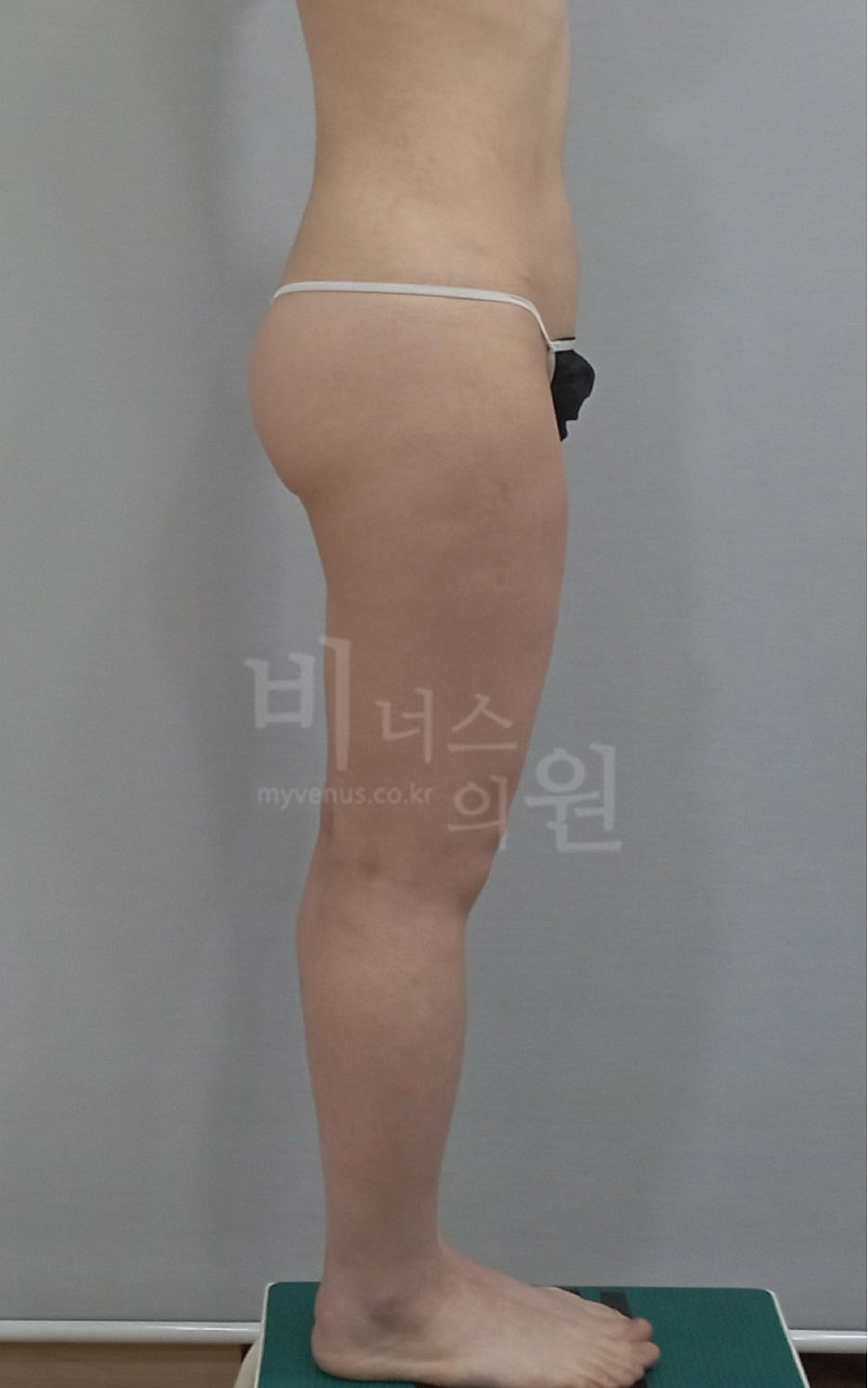 허벅지 지방흡입 재수술 전 측면 사진