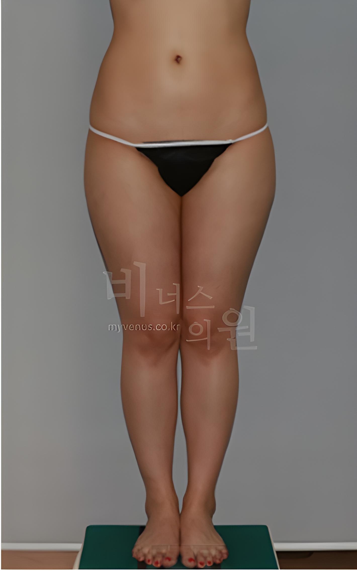허벅지 지방흡입 수술 후 정면