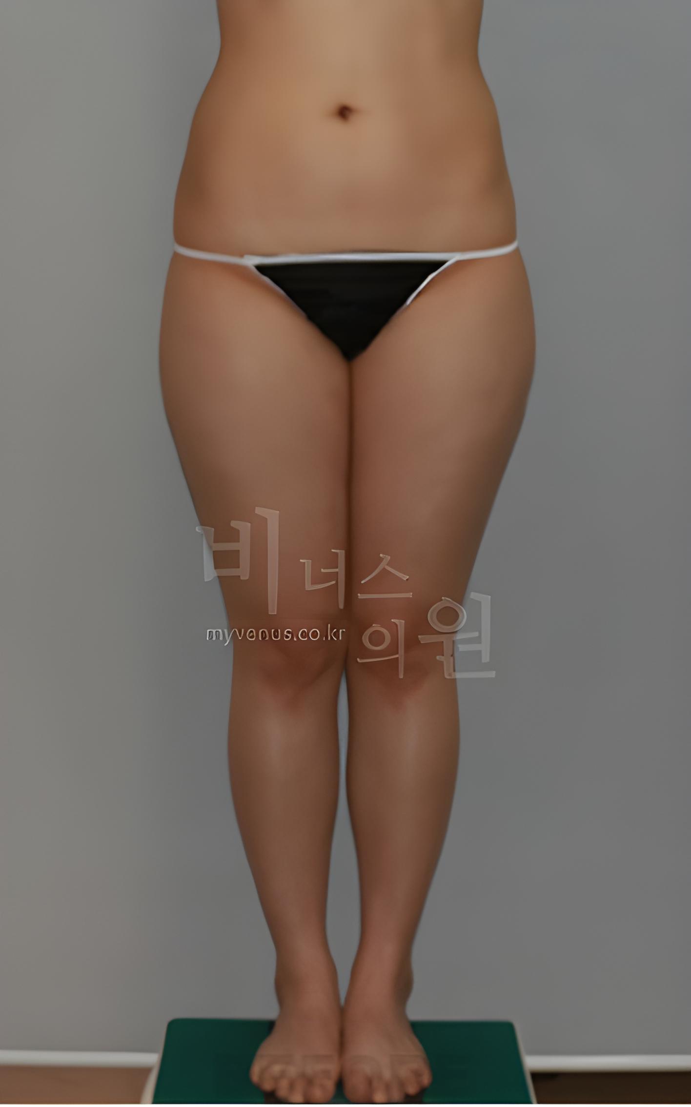 허벅지 지방흡입 수술 전 정면