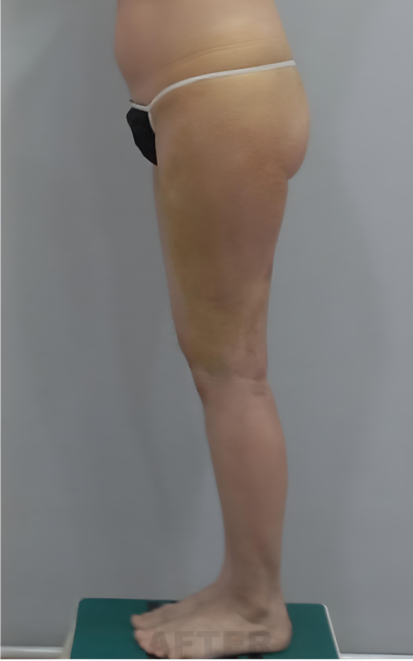 허벅지 지방흡입 수술 후 측면