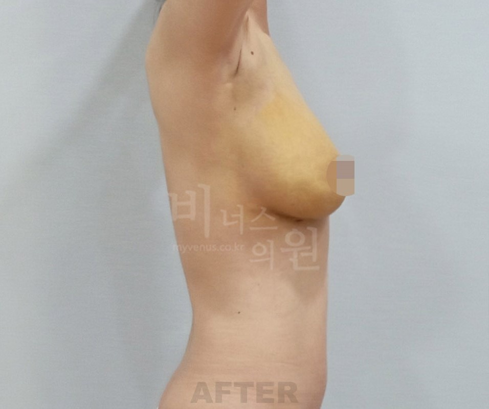 가슴축소 지방흡입 수술 후 측면 B