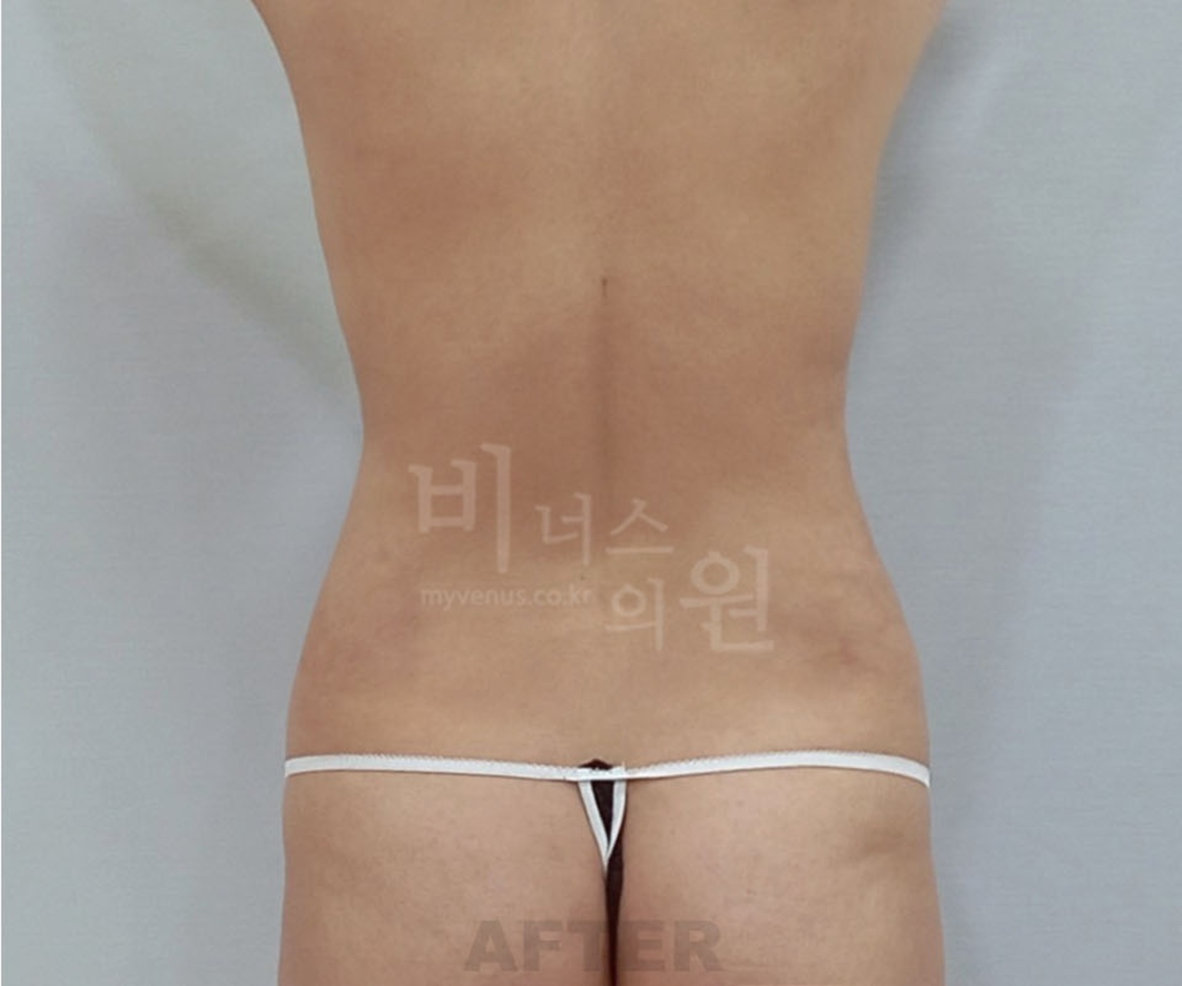 복부지방흡입 수술 후 후면