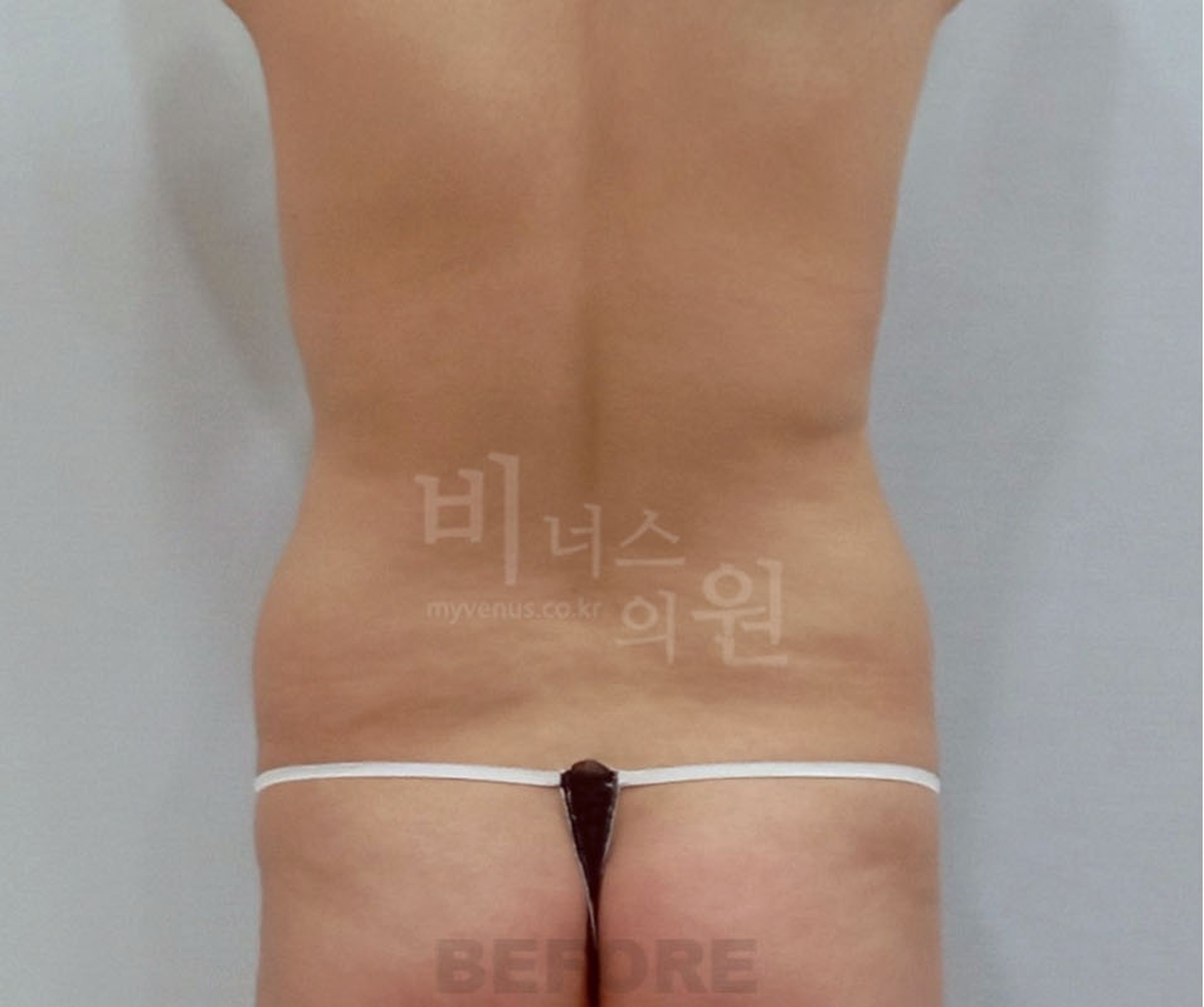 복부지방흡입 수술 전 후면