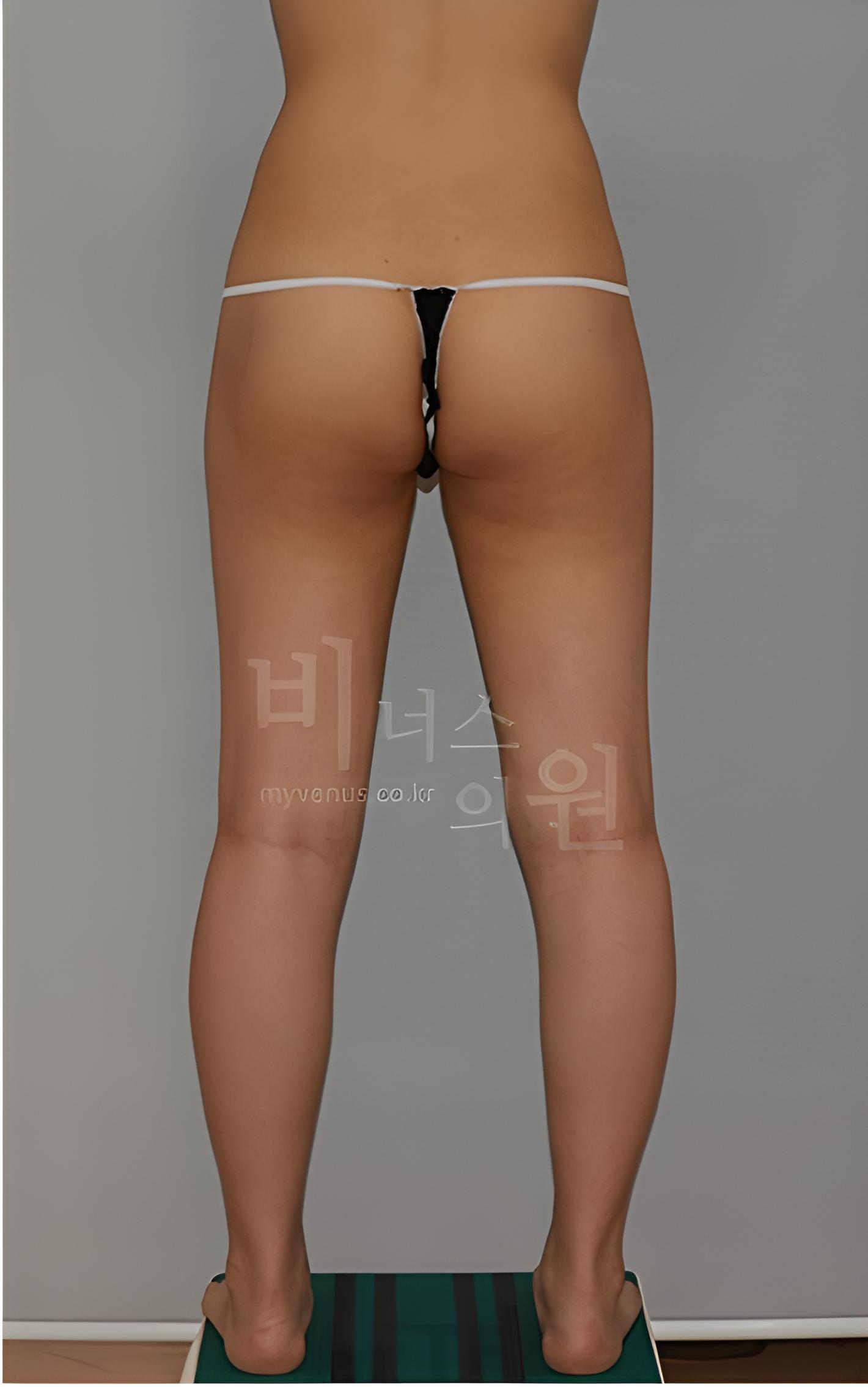 엉덩이 지방흡입·지방이식 수술 후 1개월 후면