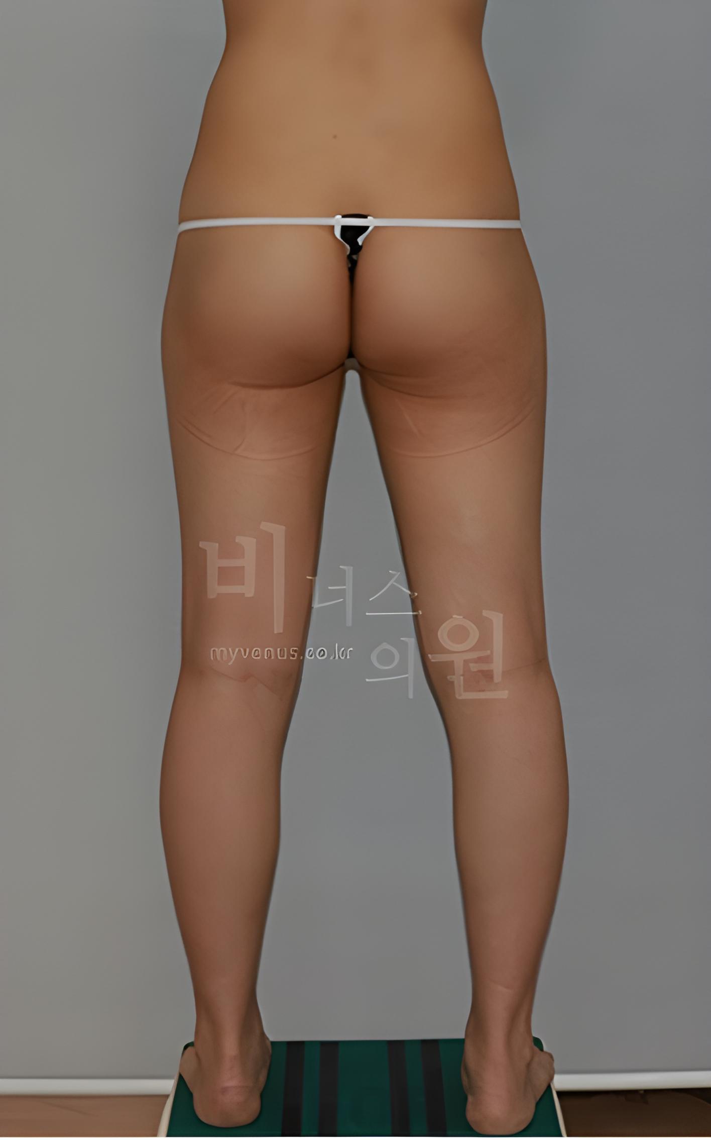 엉덩이 지방흡입·지방이식 수술 전 후면