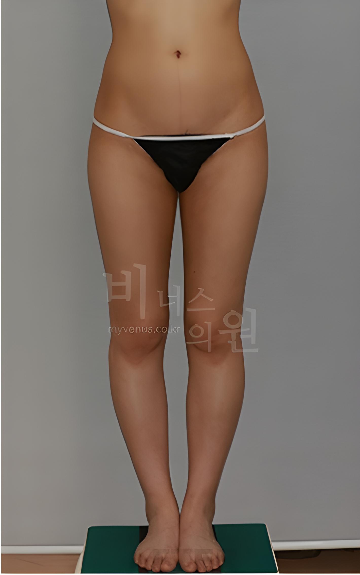 엉덩이 지방흡입·지방이식 수술 후 1개월 정면