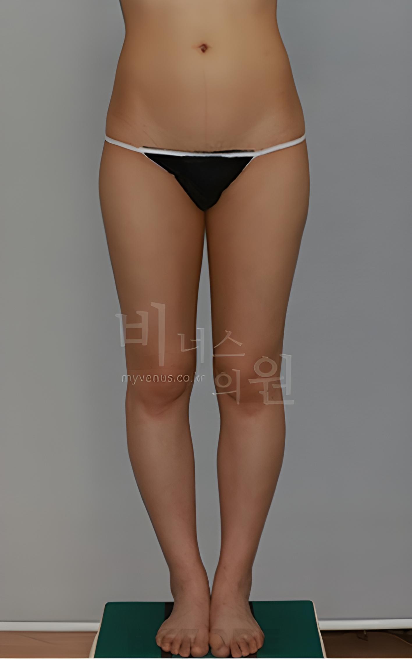 엉덩이 지방흡입·지방이식 수술 전 정면