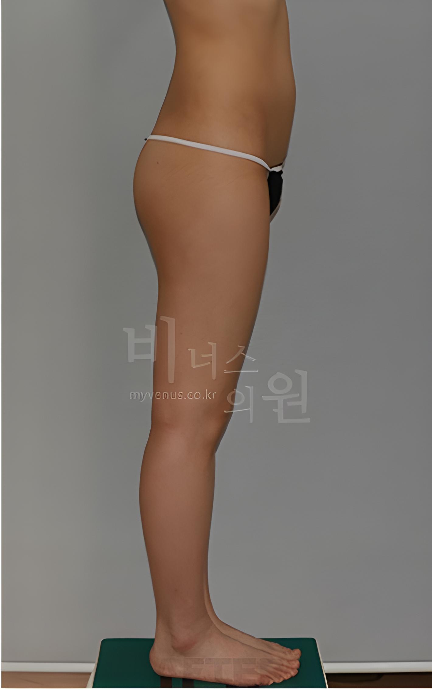엉덩이 지방흡입·지방이식 수술 후 1개월 반대 측면