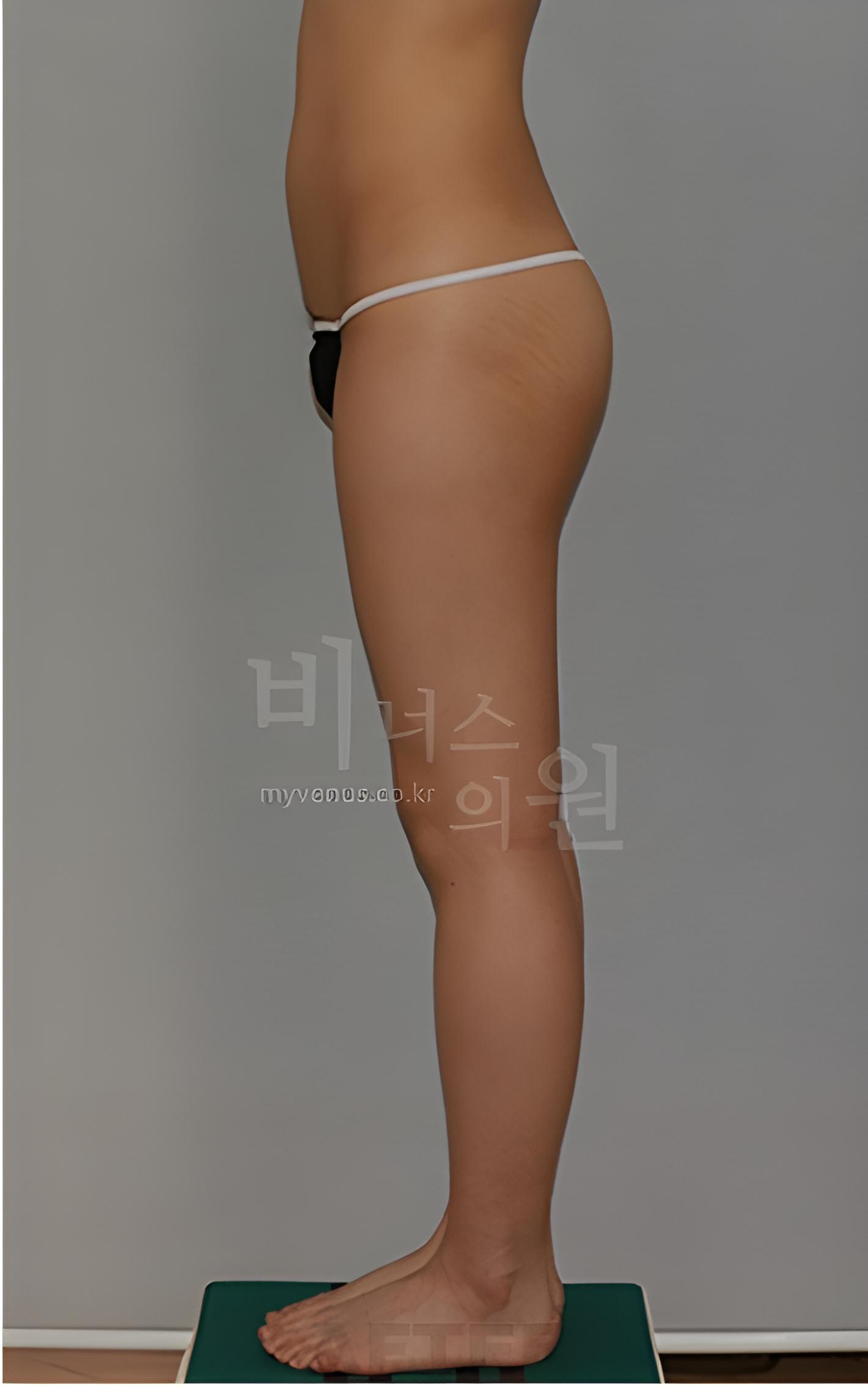 엉덩이 지방흡입·지방이식 수술 후 1개월 측면