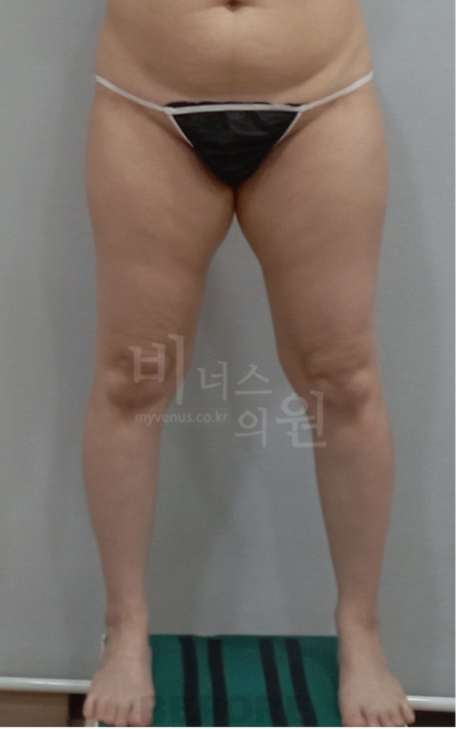 허벅지지방흡입 수술 전 정면 사례3 하체 라인