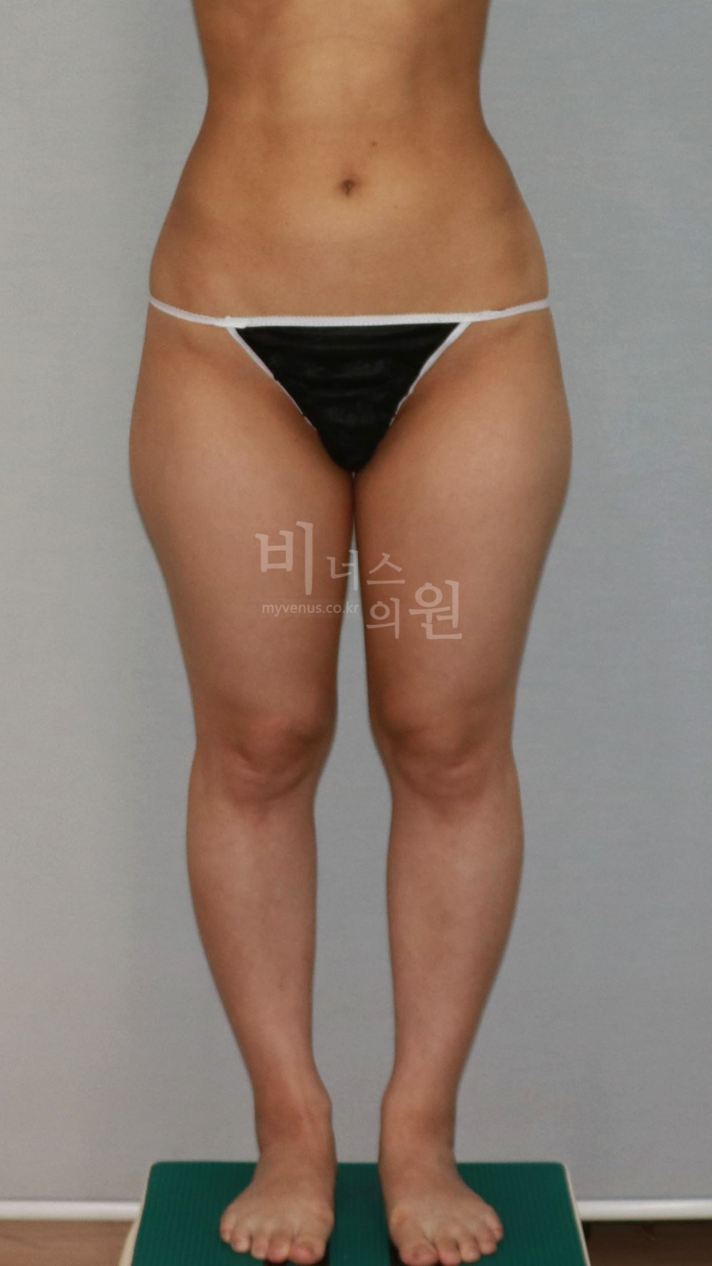 허벅지 지방흡입 수술 전 정면