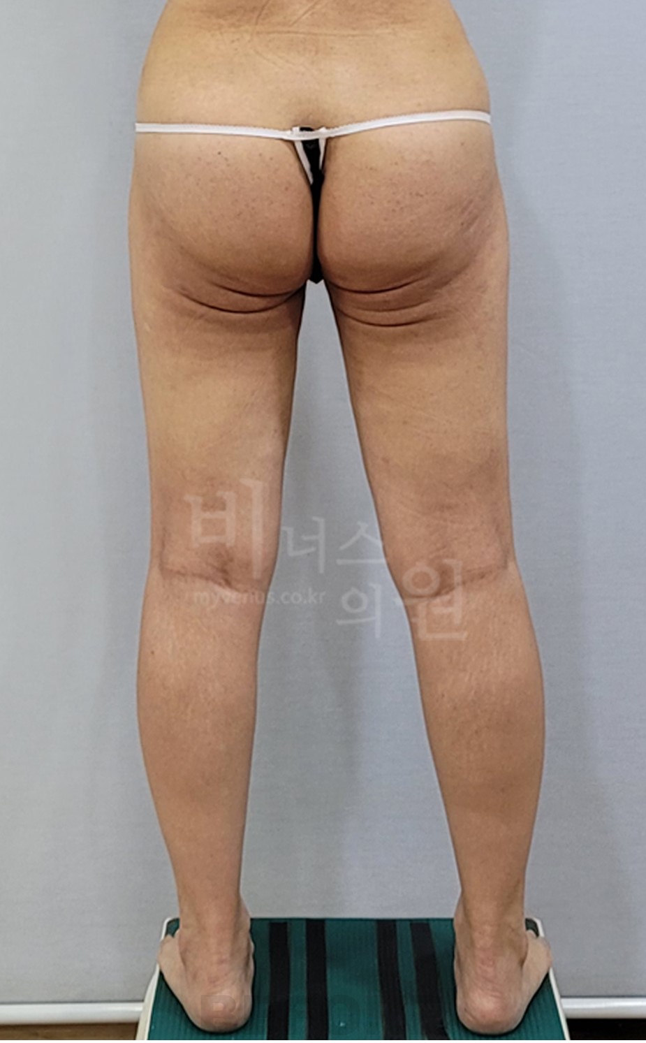 엉덩이·허벅지 지방흡입 수술 전 후면 사진